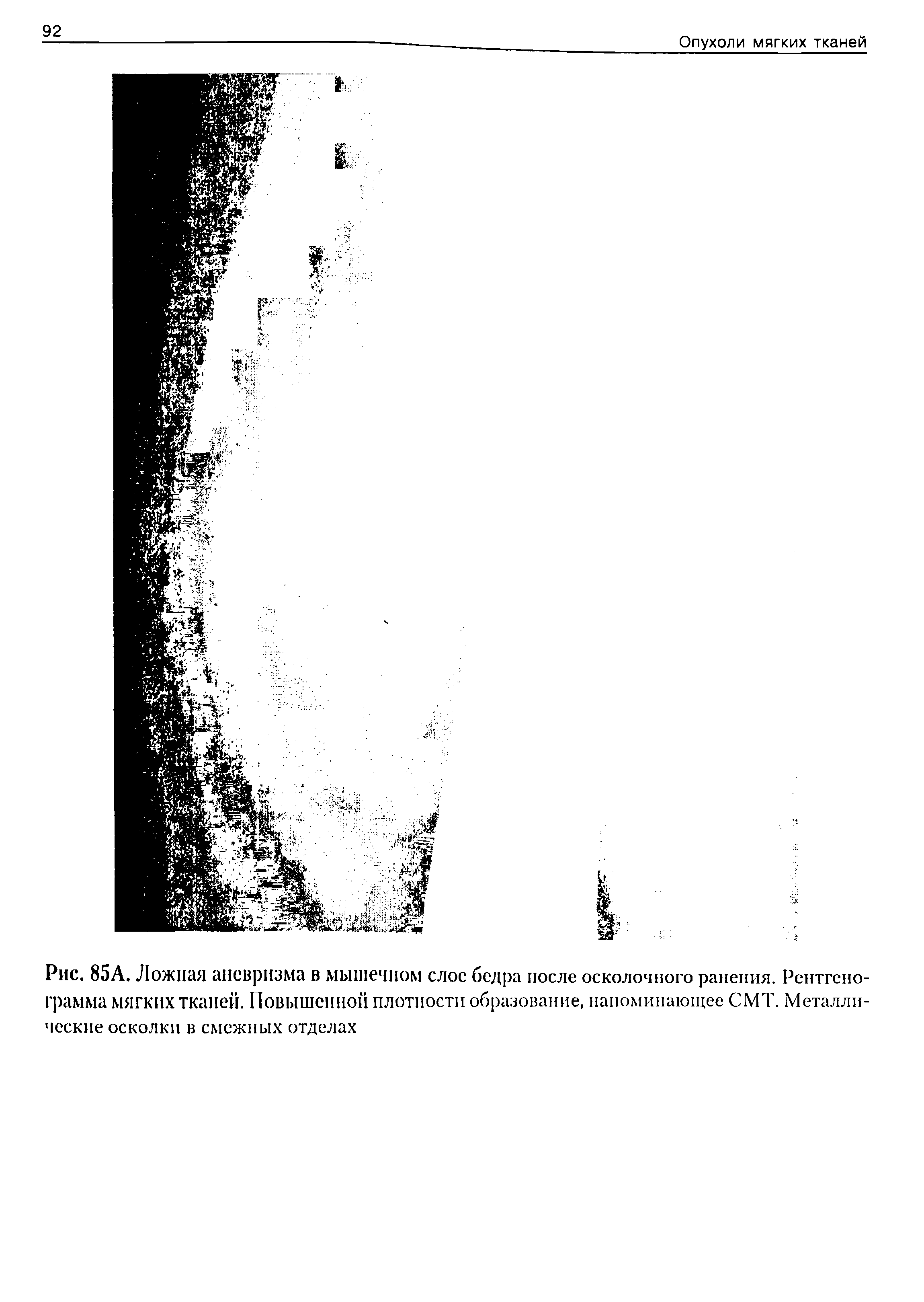 Рис. 85А. Ложная аневризма в мышечном слое бедра после осколочного ранения. Рентгенограмма МЯГКИХ тканей. Повышенной плотности образование, напоминающее СМТ. Металлические осколки в смежных отделах...