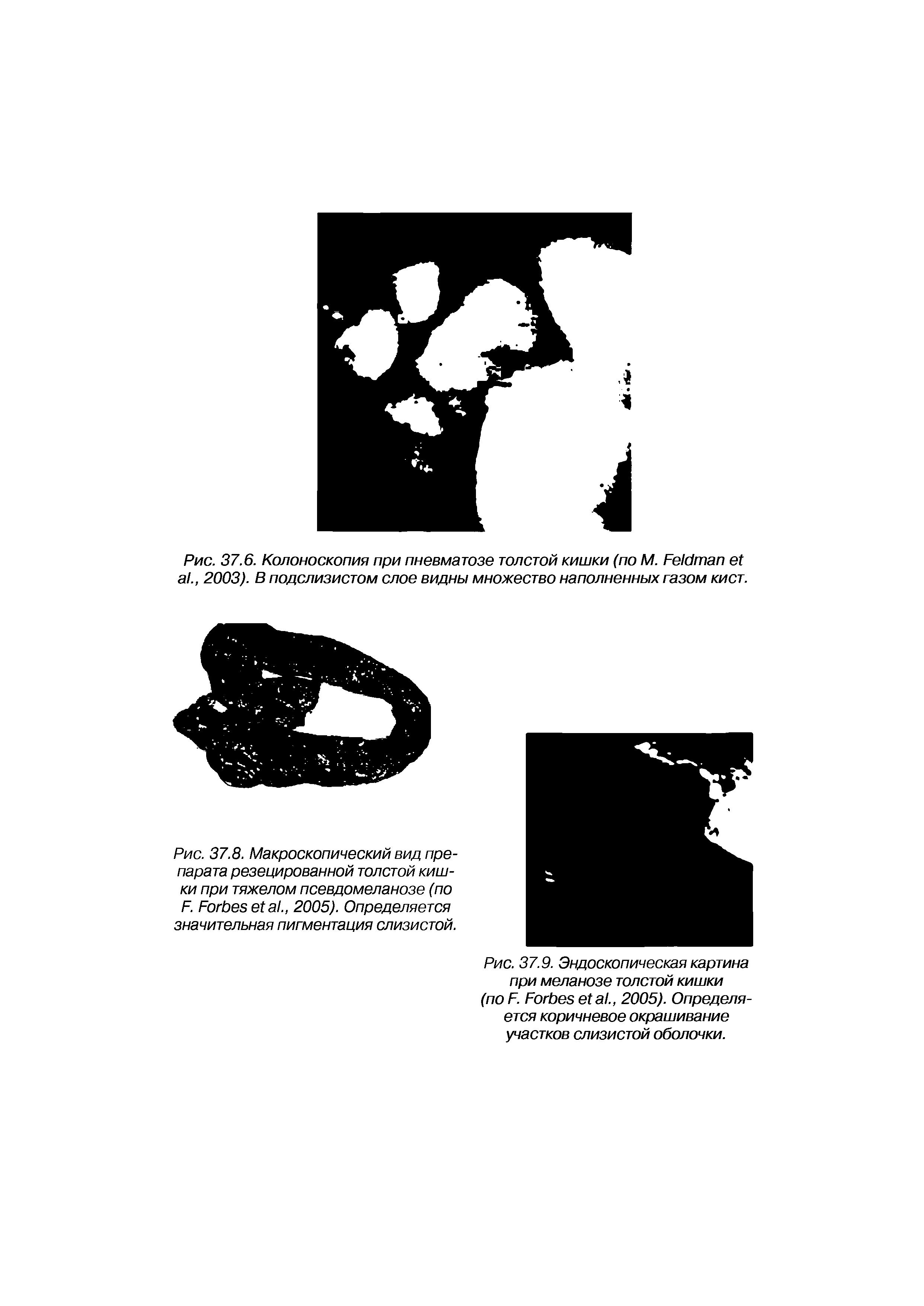 Рис. 37.9. Эндоскопическая картина при меланозе толстой кишки (по F. F ., 2005). Определяется коричневое окрашивание участков слизистой оболочки.