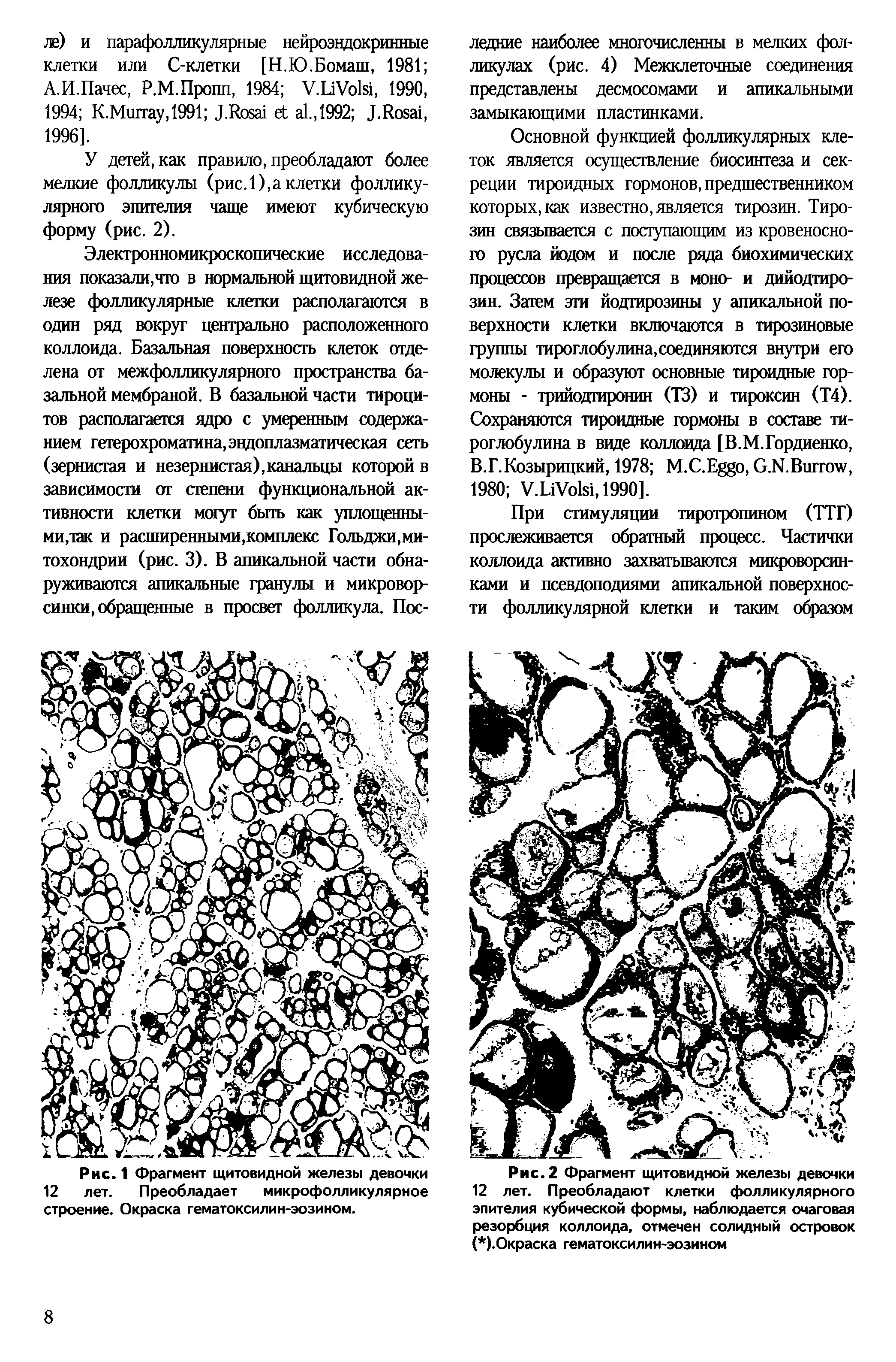 Рис. 2 Фрагмент щитовидной железы девочки 12 лет. Преобладают клетки фолликулярного эпителия кубической формы, наблюдается очаговая резорбция коллоида, отмечен солидный островок ( ).Окраска гематоксилин-эозином...