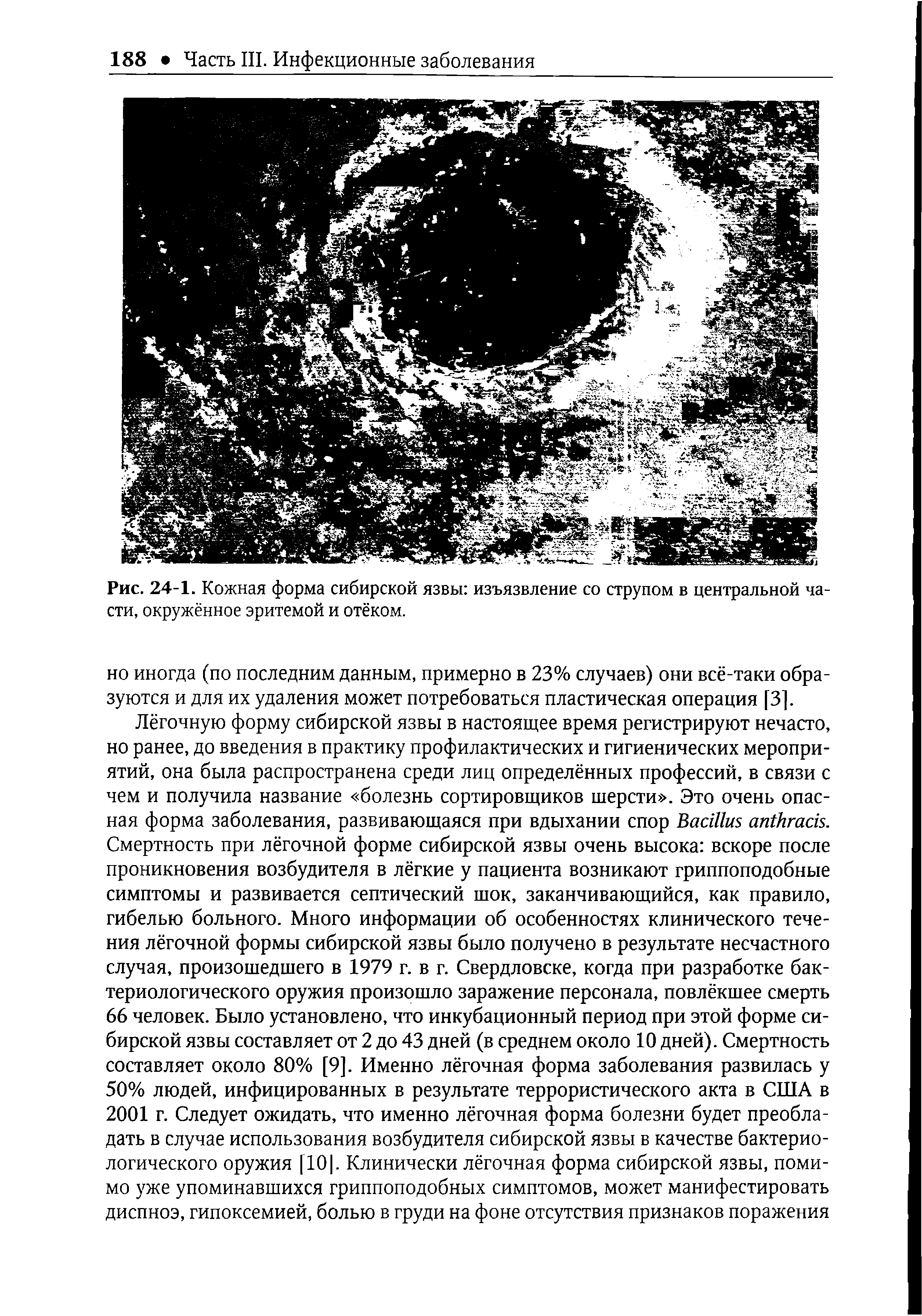 Рис. 24-1. Кожная форма сибирской язвы изъязвление со струпом в центральной части, окружённое эритемой и отёком.