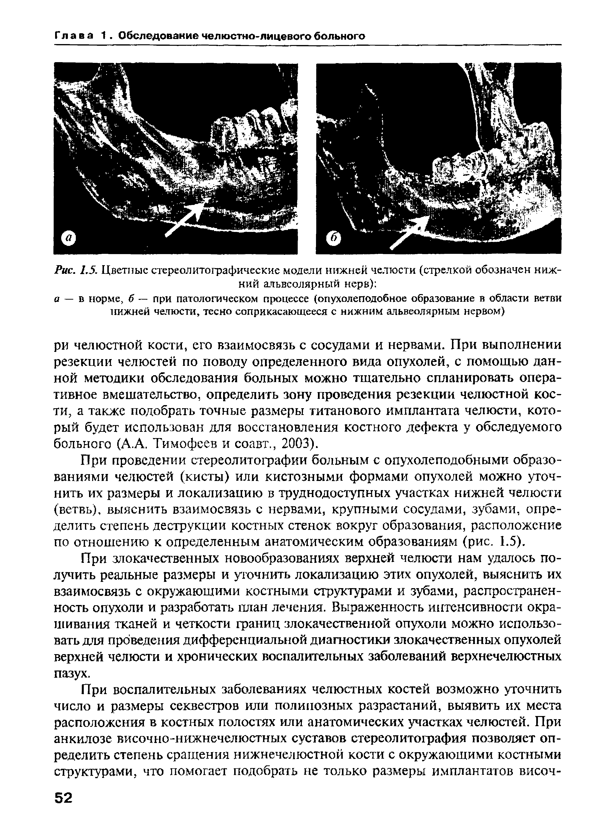 Рис. 1.5. Цветные стереолитографические модели нижней челюсти (стрелкой обозначен нижний альвеолярный нерв) ...