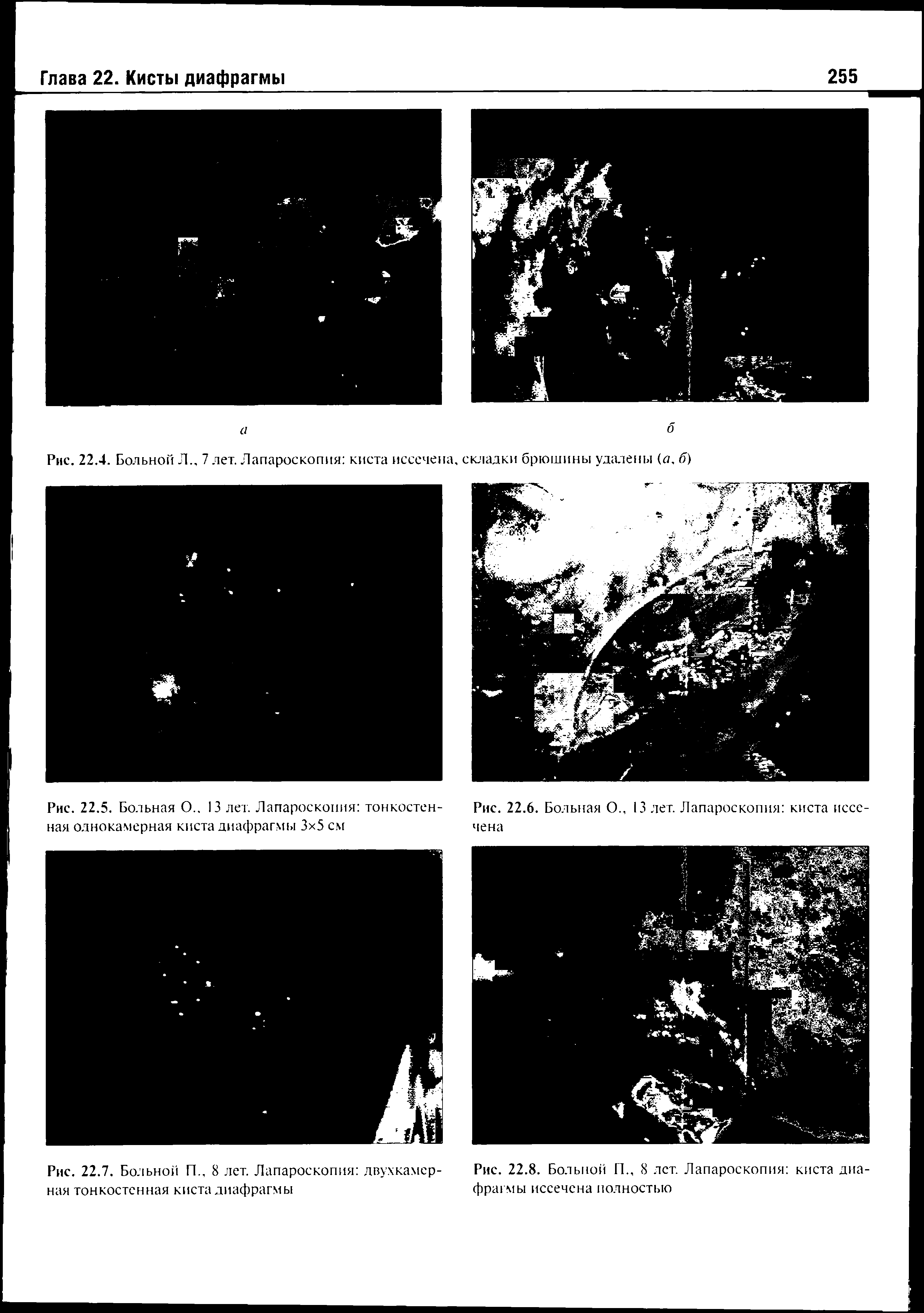 Рис. 22.8. Больной П., 8 лет. Лапароскопия киста диафрагмы иссечена полностью...