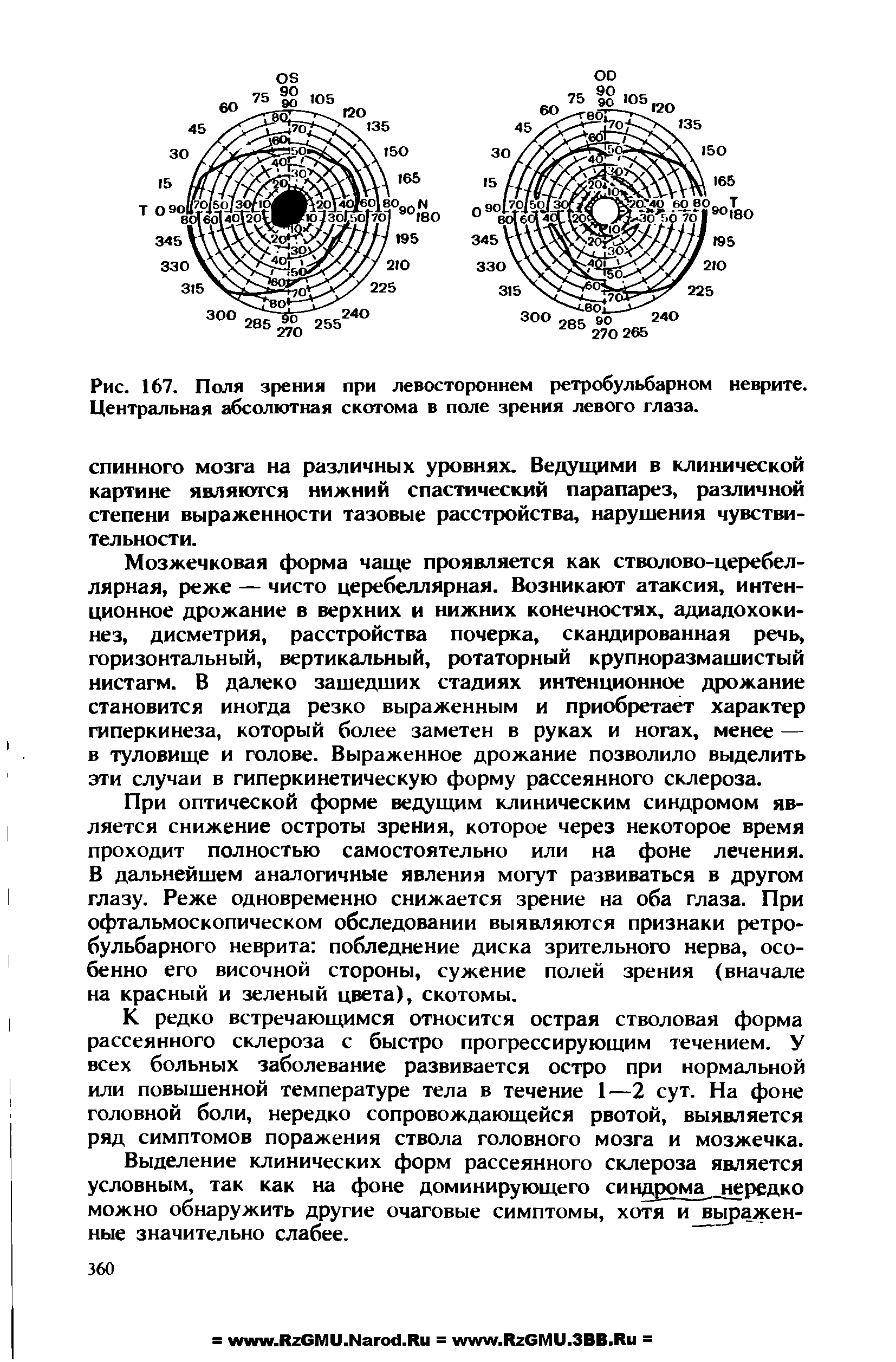 Рис. 167. Поля зрения при левостороннем ретробульбарном неврите. Центральная абсолютная скотома в поле зрения левого глаза.