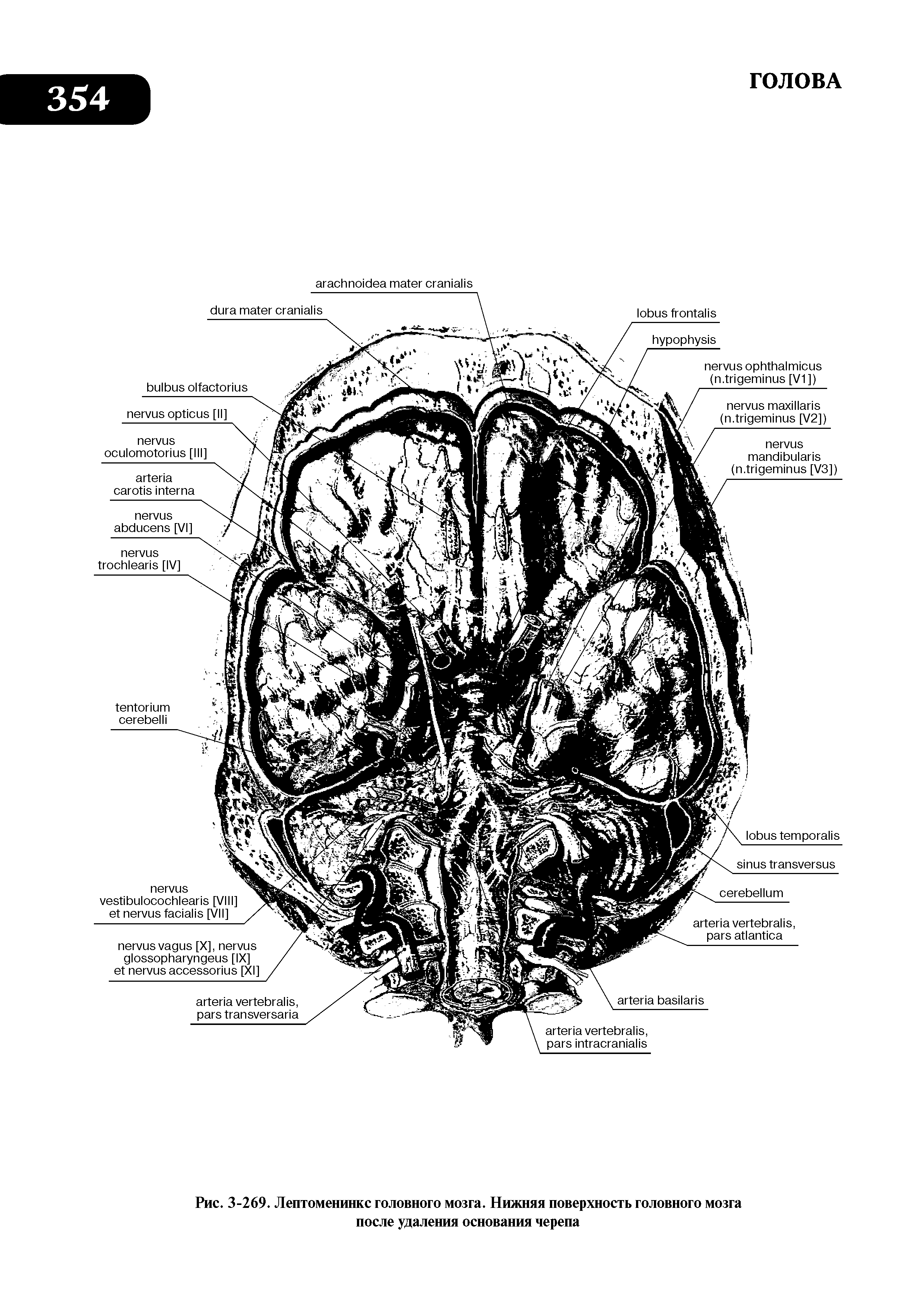 Рис. 3-269. Лептоменинкс головного мозга. Нижняя поверхность головного мозга после удаления основания черепа...