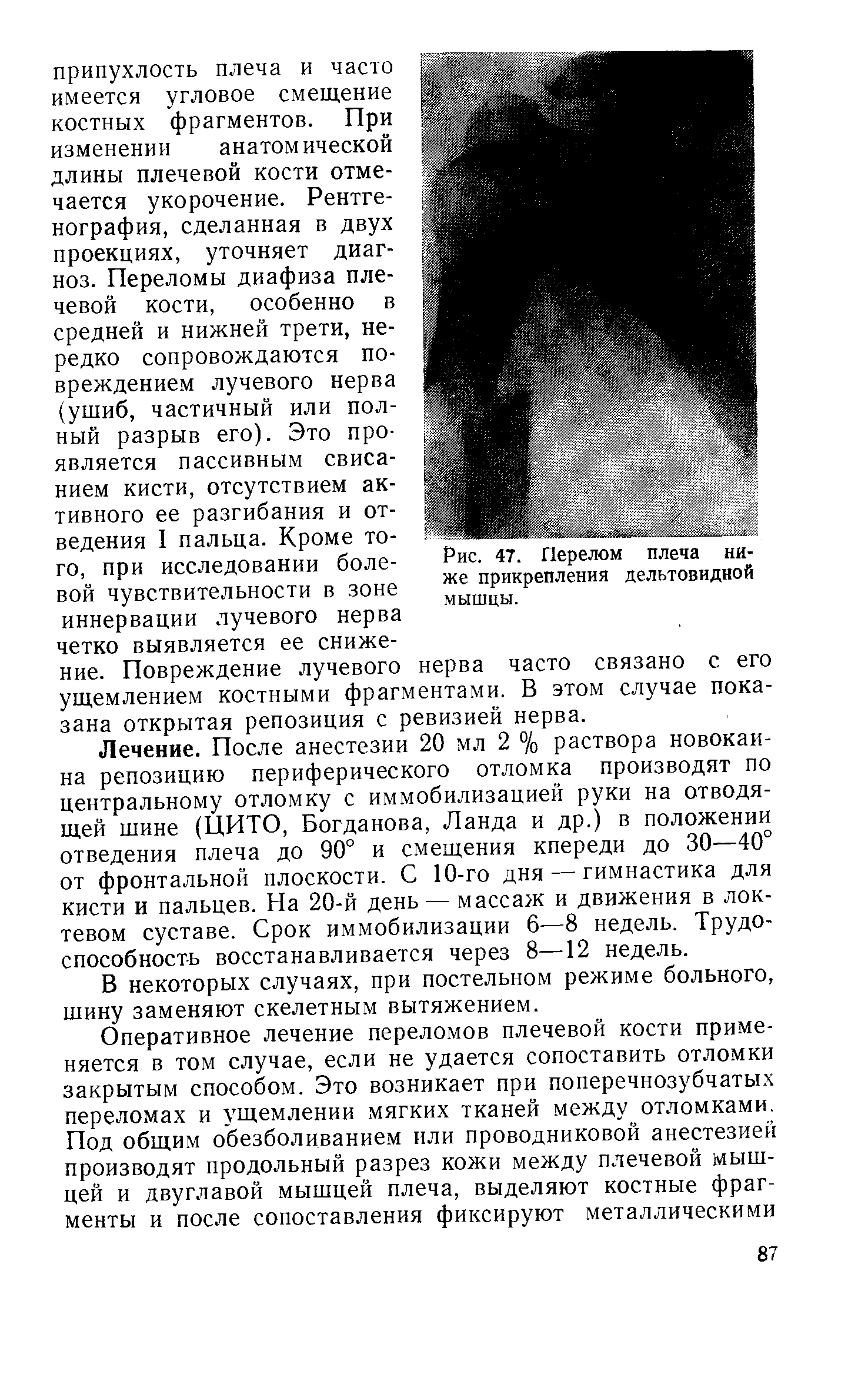 Рис. 47. Перелом плеча ниже прикрепления дельтовидной мышцы.