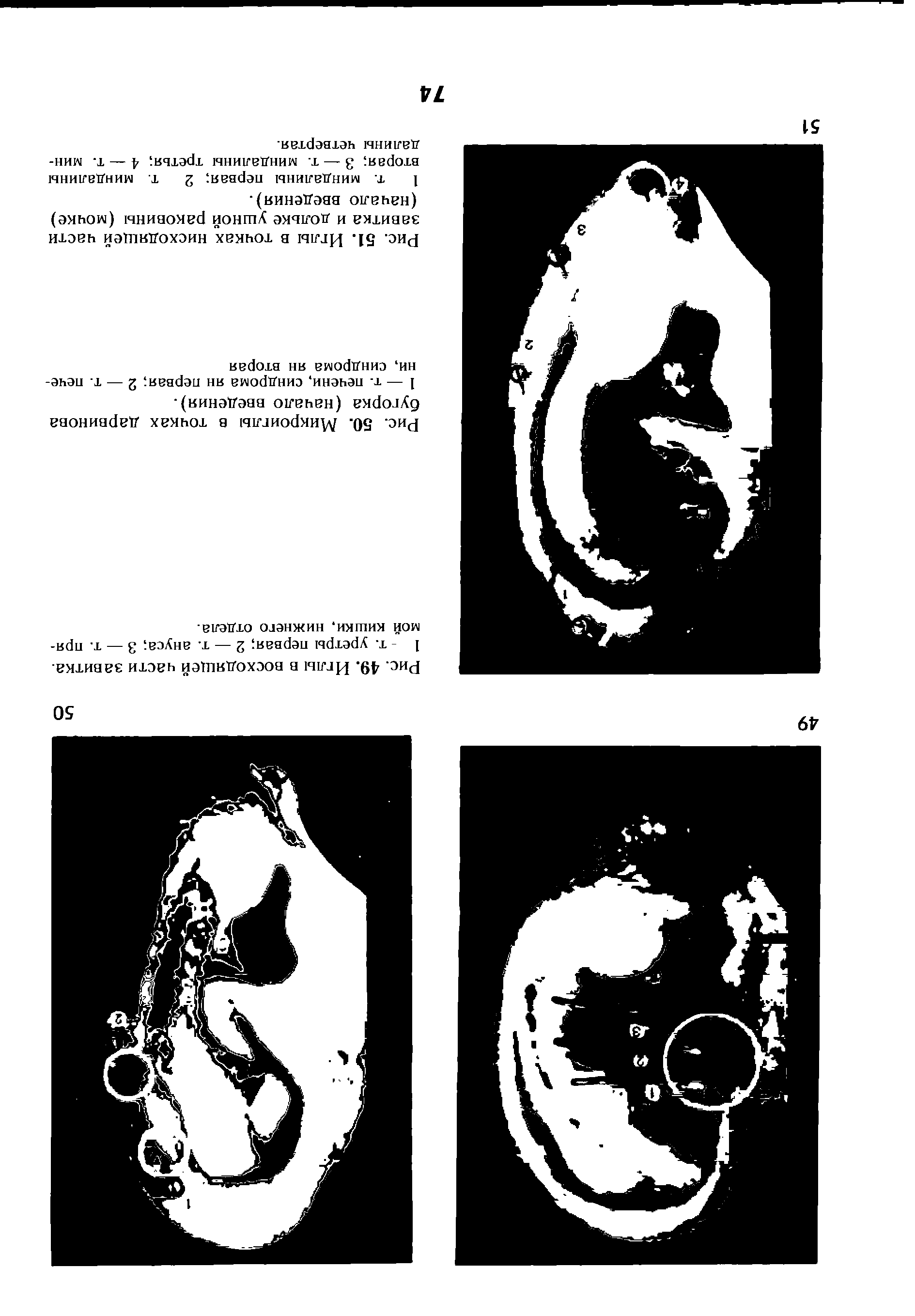 Рис. 50. Микроиглы в точках дарвинова бугорка (начало введения).