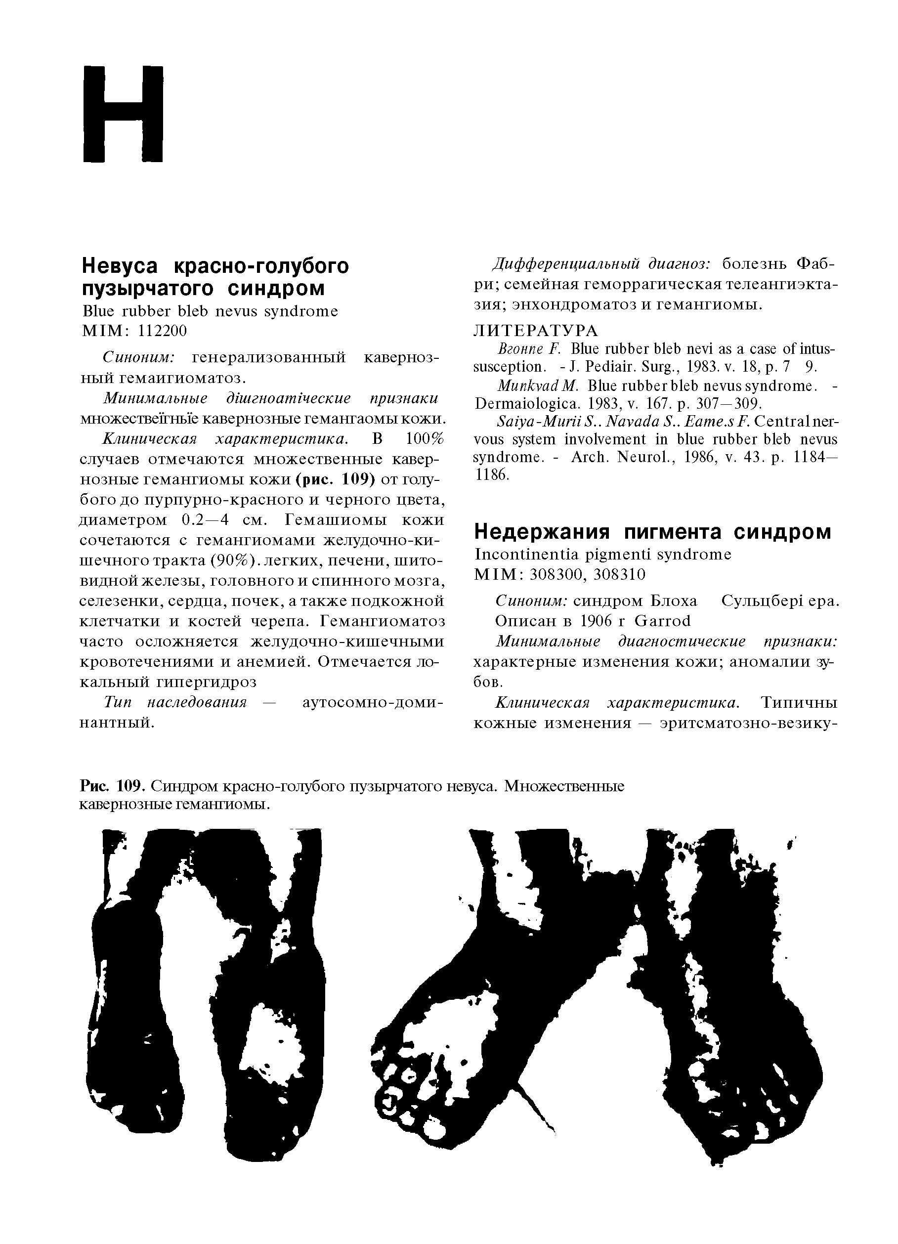 Рис. 109. Синдром красно-голубого пузырчатого невуса. Множественные кавернозные гемангиомы.