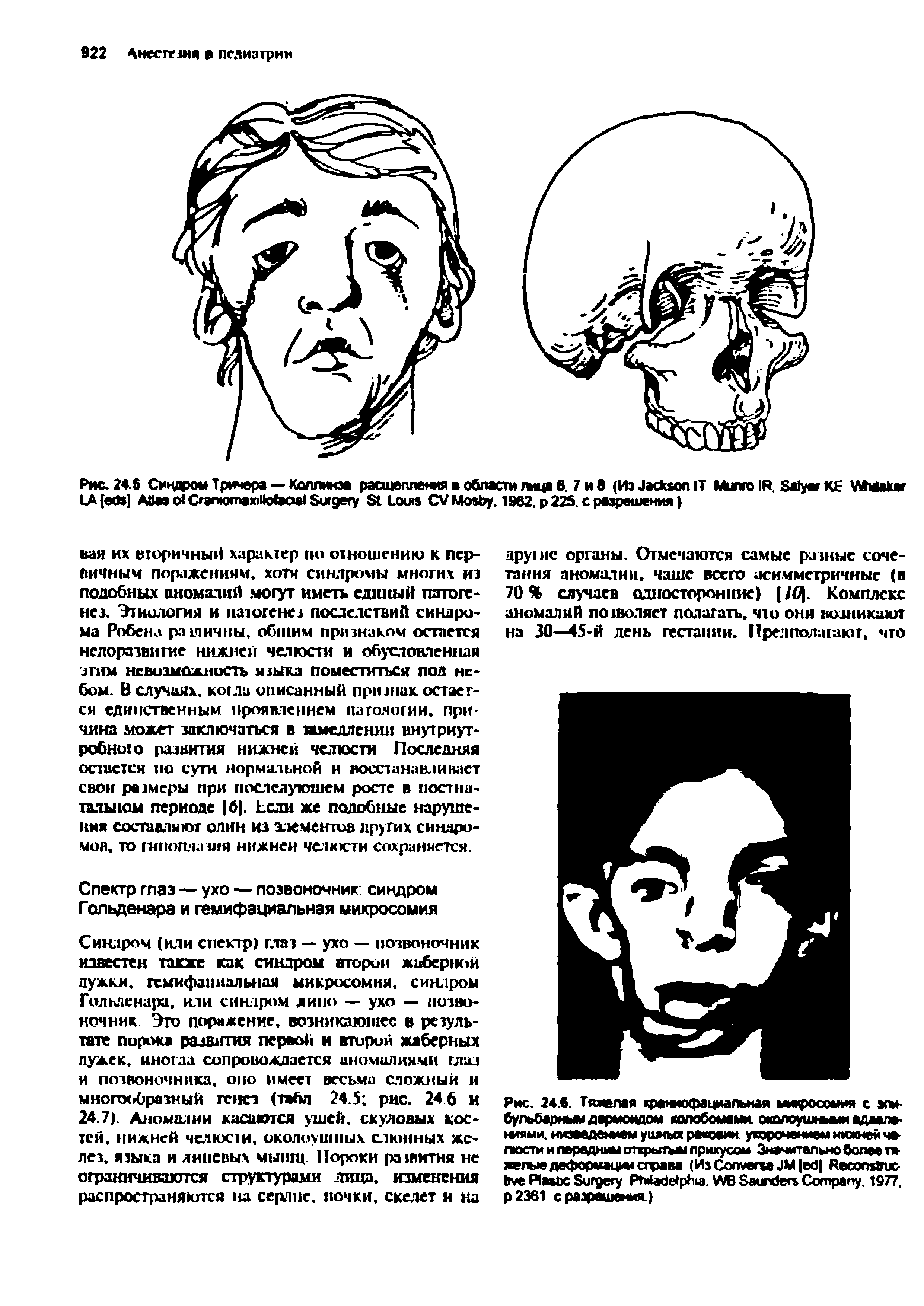 Рис. 245 Синдром Тричера — Коллинза расщеплет в области лица 6. 7 и В (Из J IT M IR. S KE WM LA [ ] A C U S S L CV M . 1982. 225. с разрешения)...