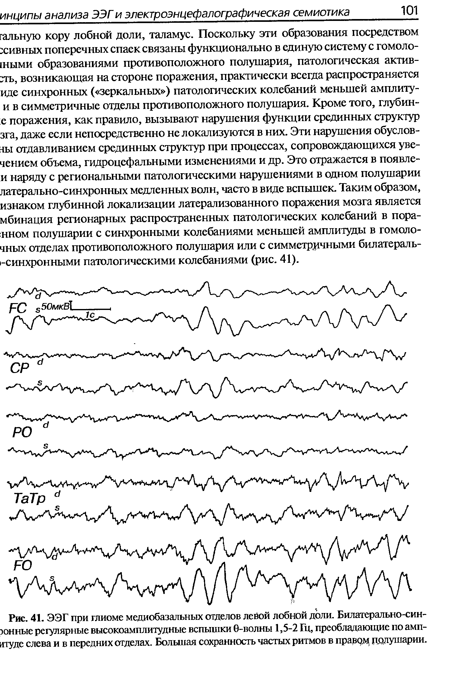 Рис. 41. ЭЭГ при глиоме медиобазальных отделов левой лобной доли. Билатерально-син-эонные регулярные высокоамплитудные вспышки 6-волны 1,5-2 Гц, преобладающие по амп-итуде слева и в передних отделах. Большая сохранность частых ритмов в правом полушарии.