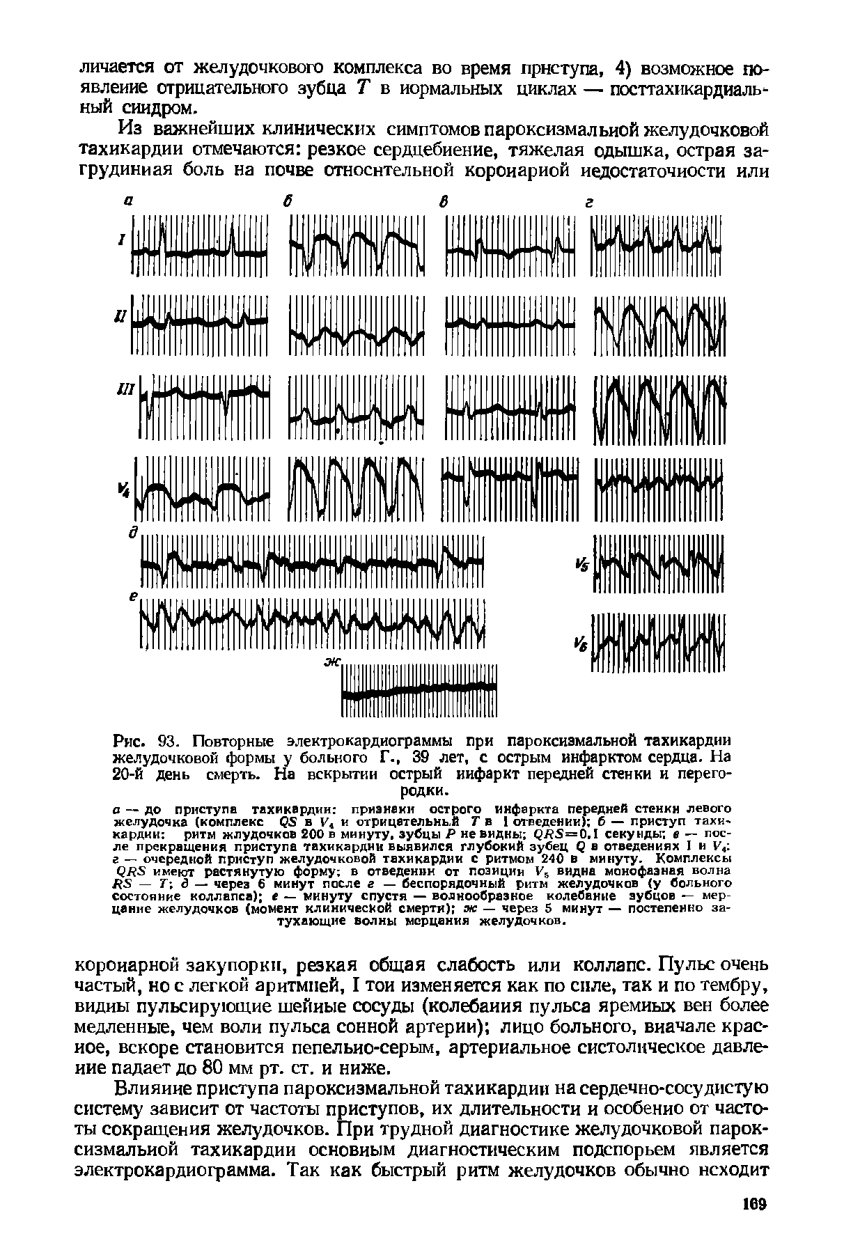 Рис. 93. Повторные электрокардиограммы при пароксизмальной тахикардии желудочковой формы у больного Г., 39 лет, с острым инфарктом сердца. На 20-й день смерть. На вскрытии острый инфаркт передней стенки и перегородки.