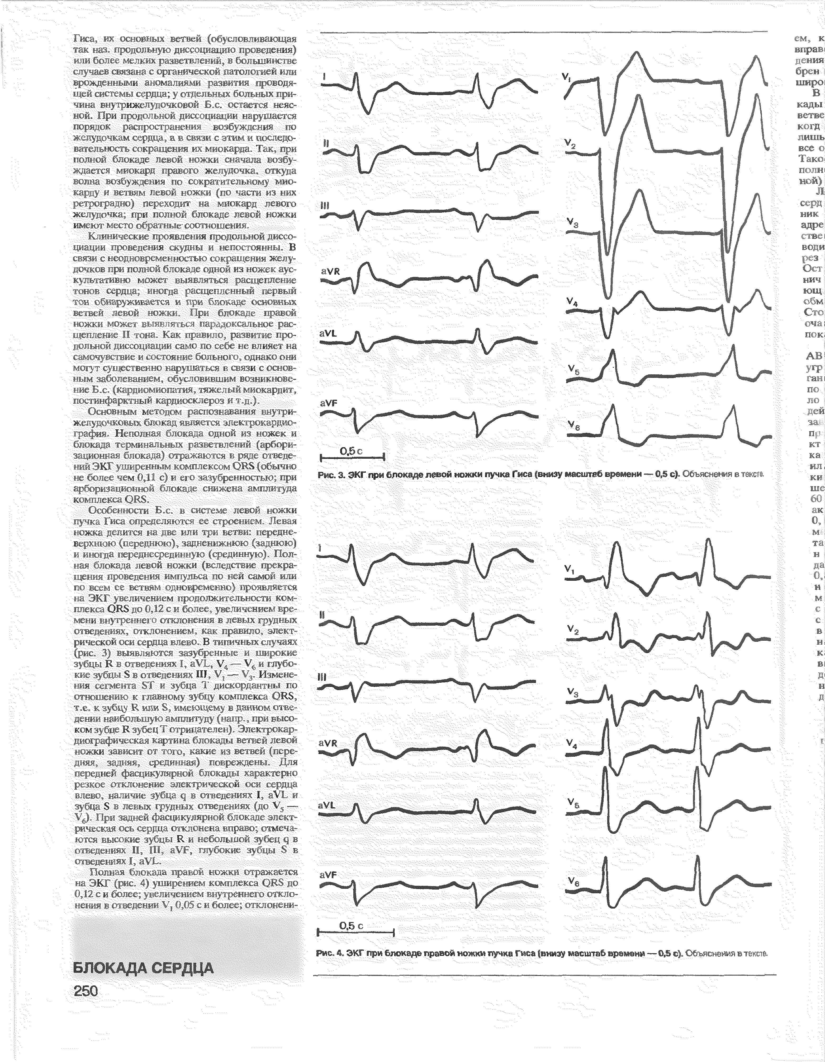 Рис. 3. ЭКГ при блокаде левой ножки пучка Гиса (внизу масштаб времени — 0,5 с). Объяснения в тексте.