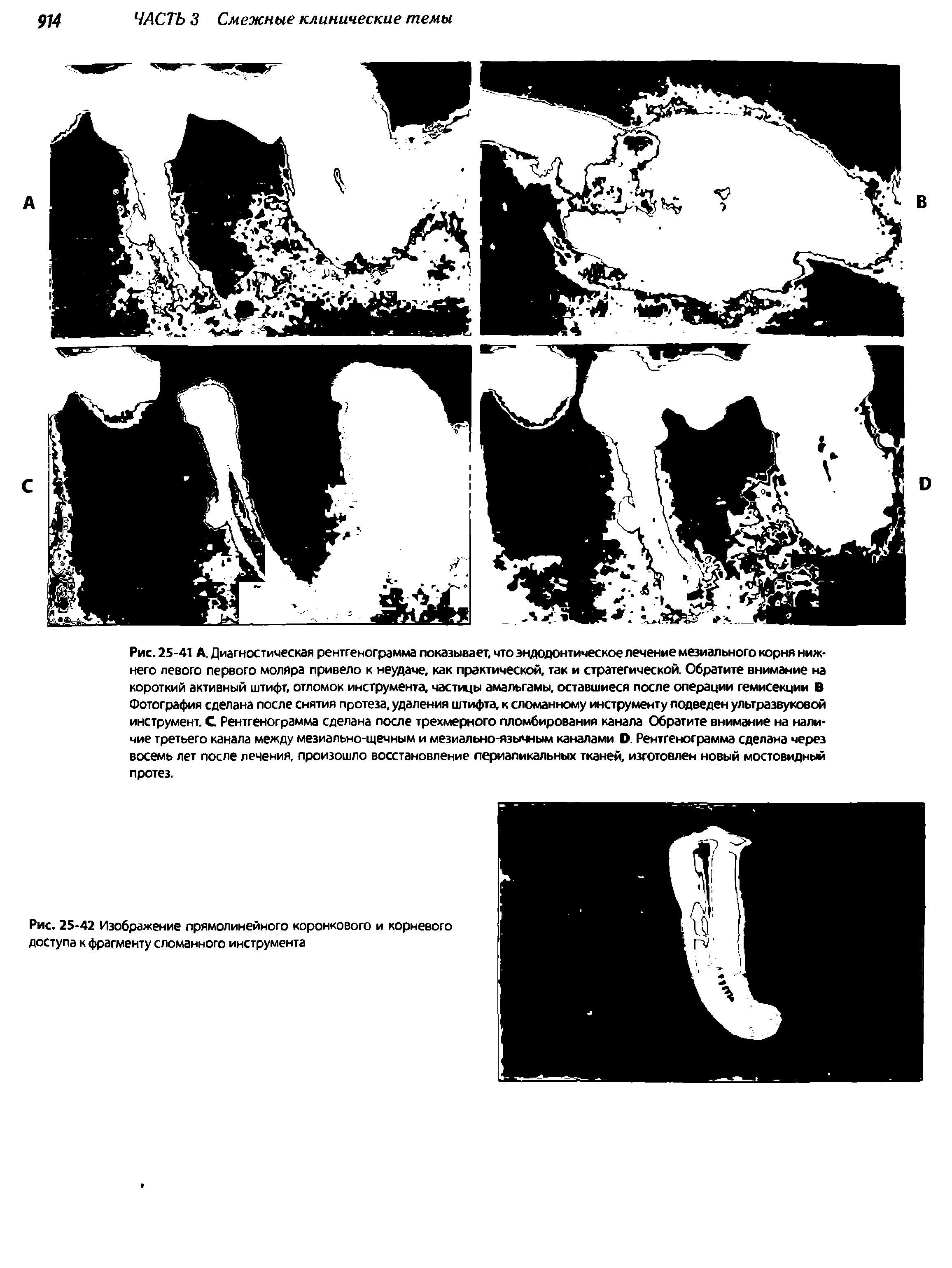 Рис. 25-42 Изображение прямолинейного коронкового и корневого доступа к фрагменту сломанного инструмента...