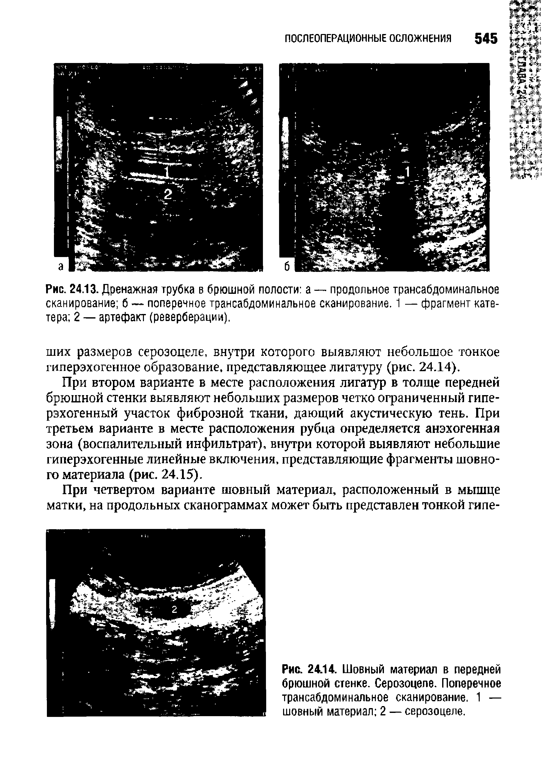 Рис. 24.13. Дренажная трубка в брюшной полости а — продольное трансабдоминальное сканирование б — поперечное трансабдоминальное сканирование. 1 — фрагмент катетера 2 — артефакт (реверберации).
