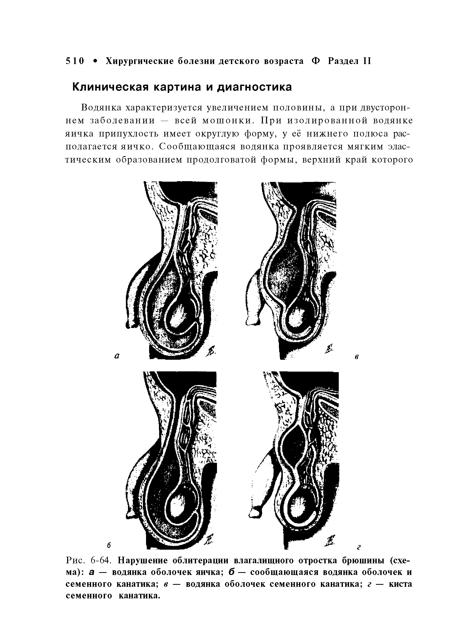 Рис. 6-64. Нарушение облитерации влагалищного отростка брюшины (схема) а — водянка оболочек яичка б — сообщающаяся водянка оболочек и семенного канатика в — водянка оболочек семенного канатика г — киста семенного канатика.
