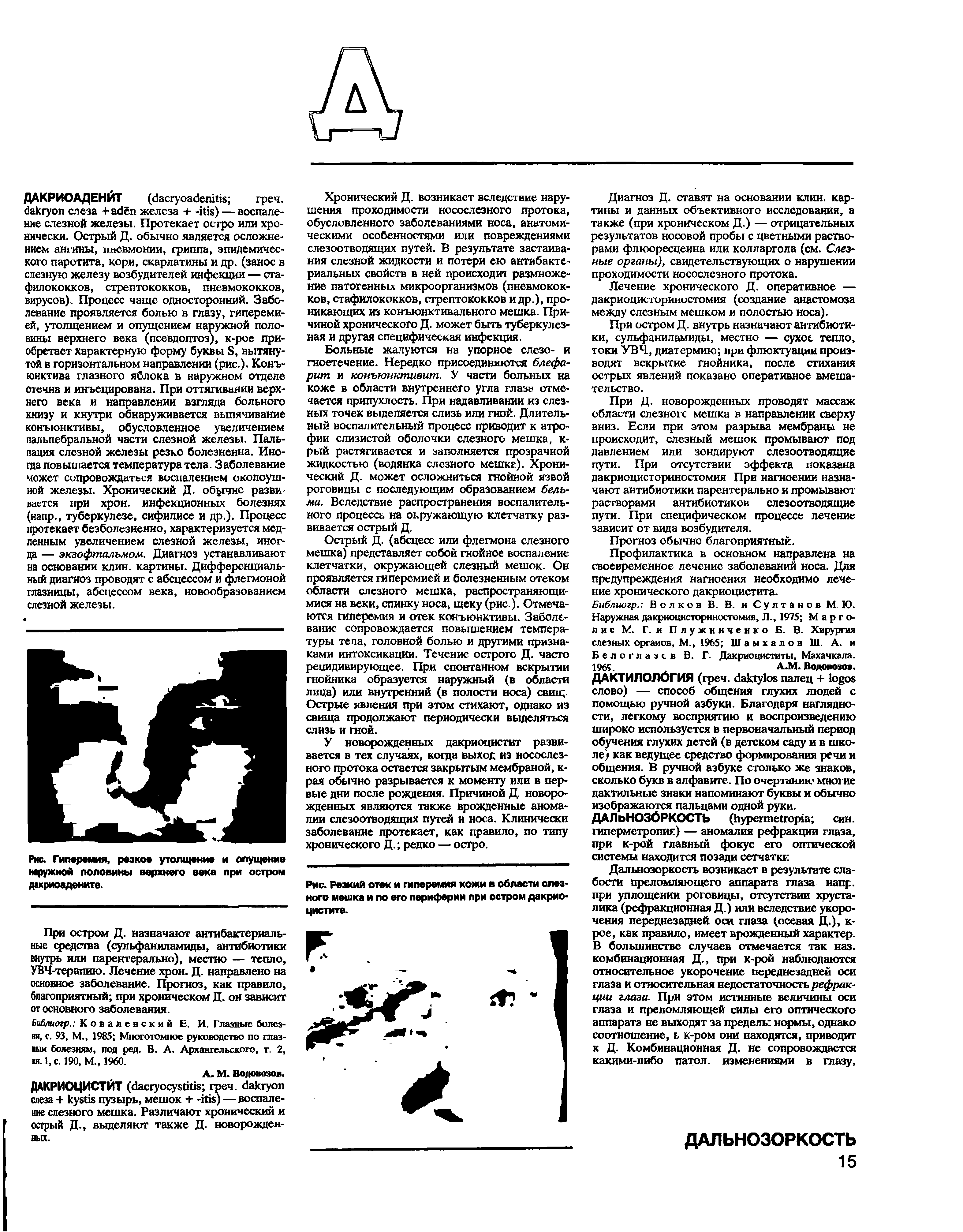 Рис. Гиперемия, резкое утолщение и опущение наружной половины верхнего века при остром дакриоадените.