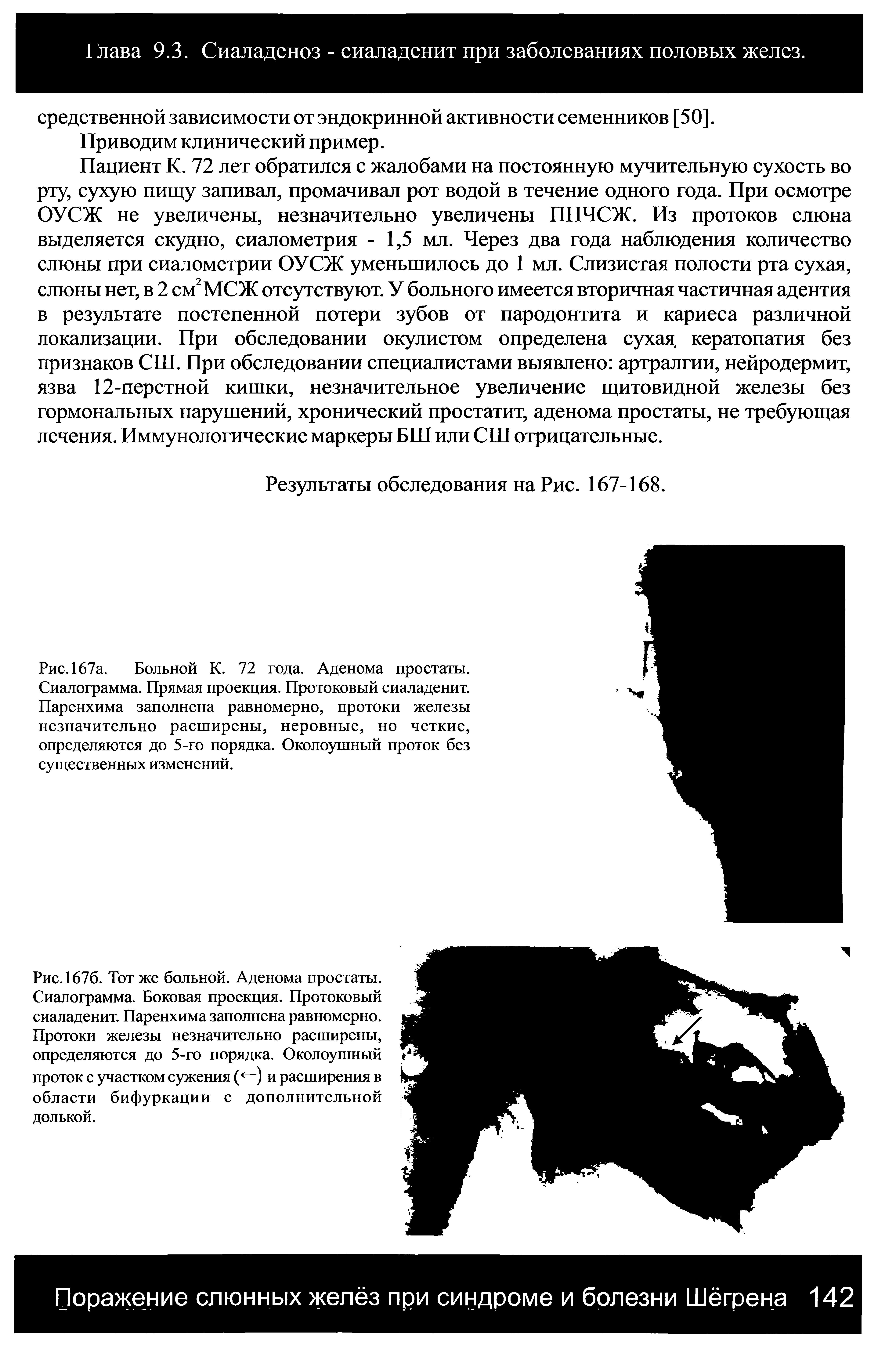 Рис. 167а. Больной К. 72 года. Аденома простаты. Сиалограмма. Прямая проекция. Протоковый сиаладенит. Паренхима заполнена равномерно, протоки железы незначительно расширены, неровные, но четкие, определяются до 5-го порядка. Околоушный проток без существенных изменений.