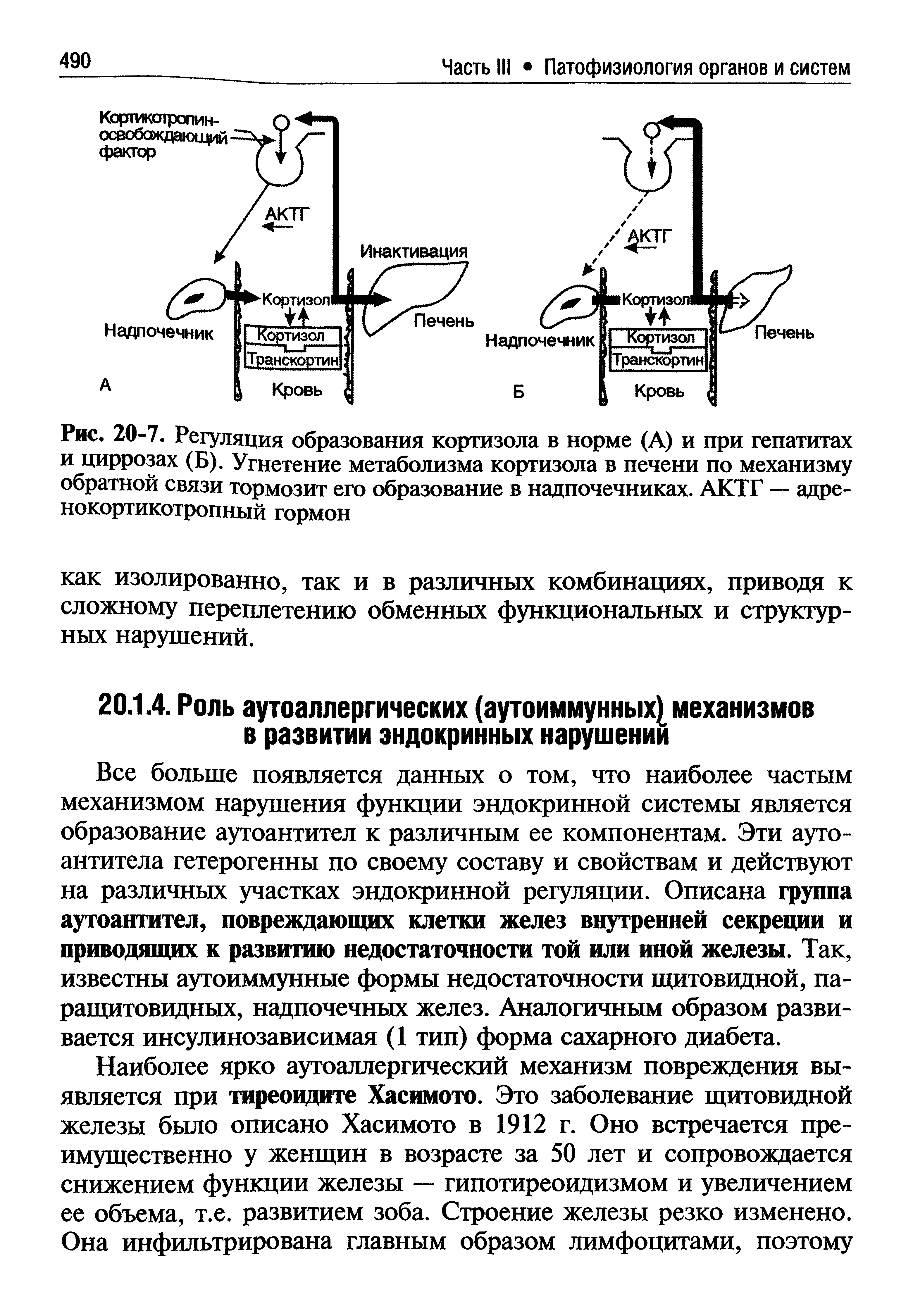 Рис. 20-7. Регуляция образования кортизола в норме (А) и при гепатитах и циррозах (Б). Угнетение метаболизма кортизола в печени по механизму обратной связи тормозит его образование в надпочечниках. АКТГ — адренокортикотропный гормон...