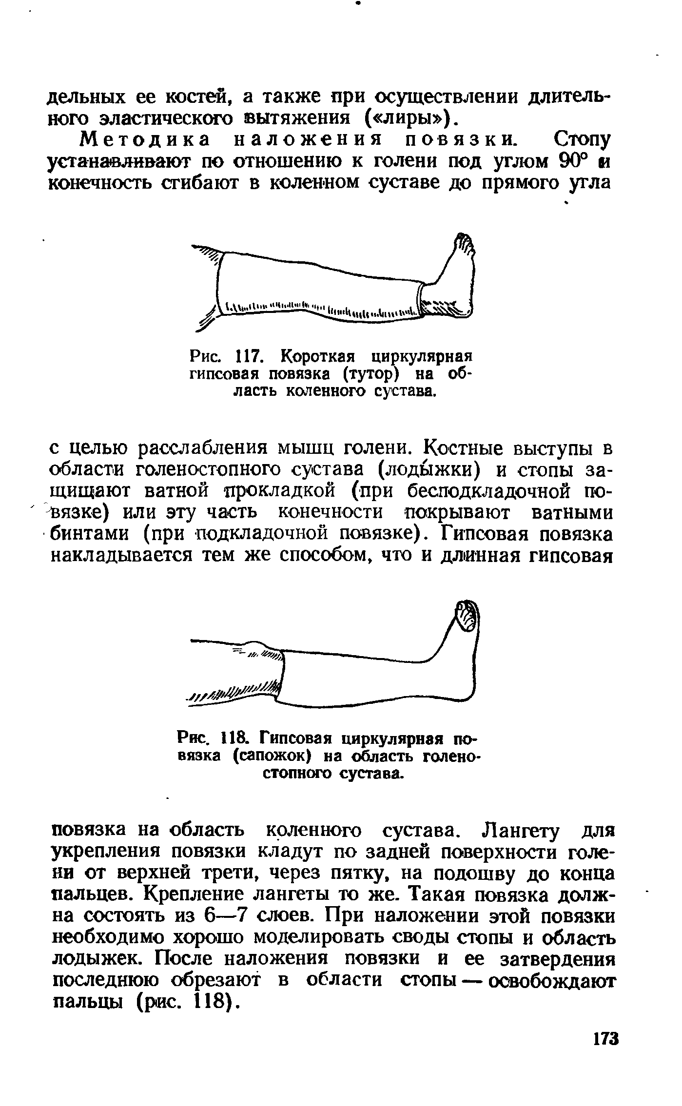 Рис. 118. Гипсовая циркулярная повязка (сапожок) на область голеностопного сустава.