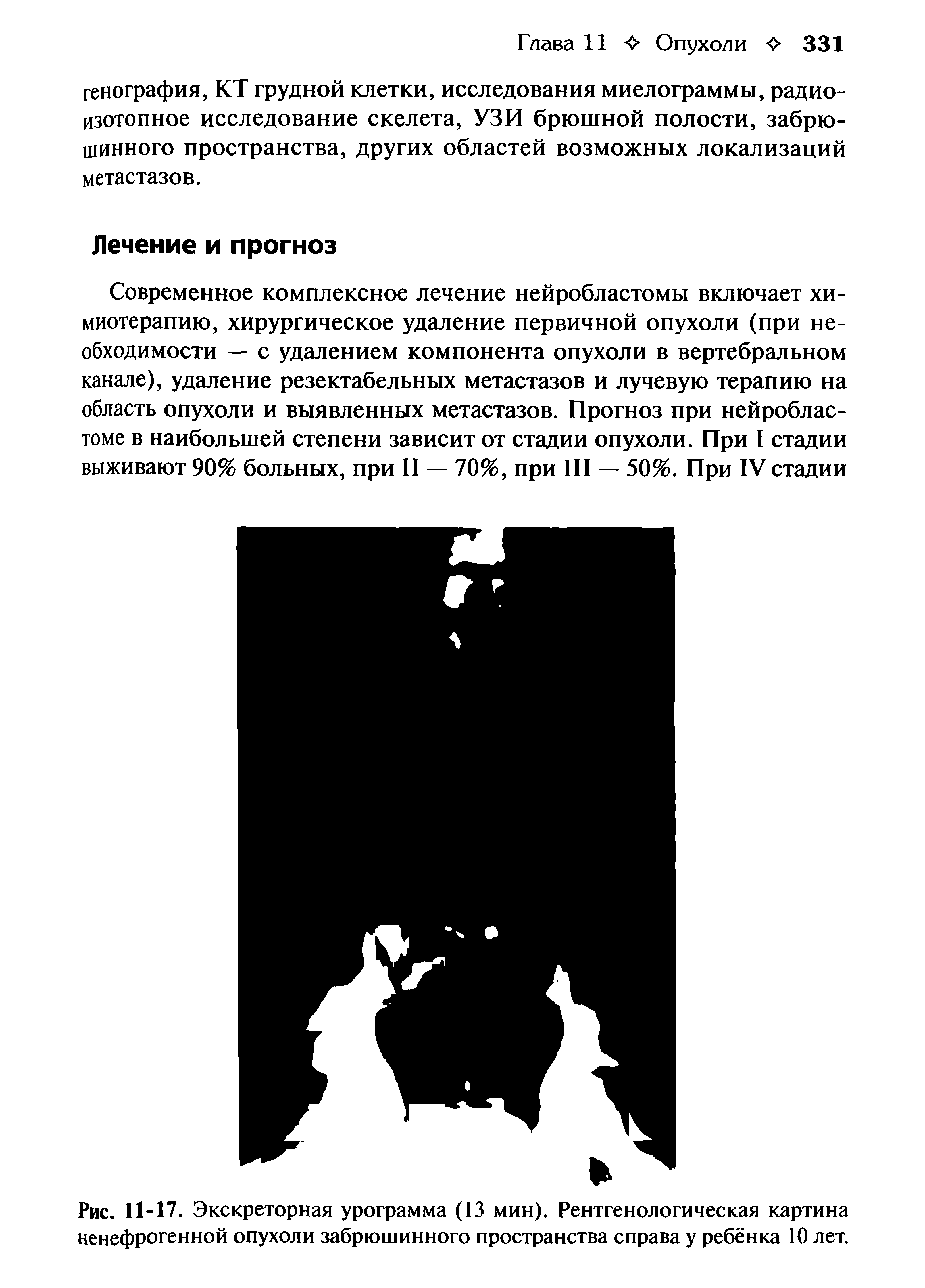 Рис. 11-17. Экскреторная урограмма (13 мин). Рентгенологическая картина ненефрогенной опухоли забрюшинного пространства справа у ребёнка 10 лет.