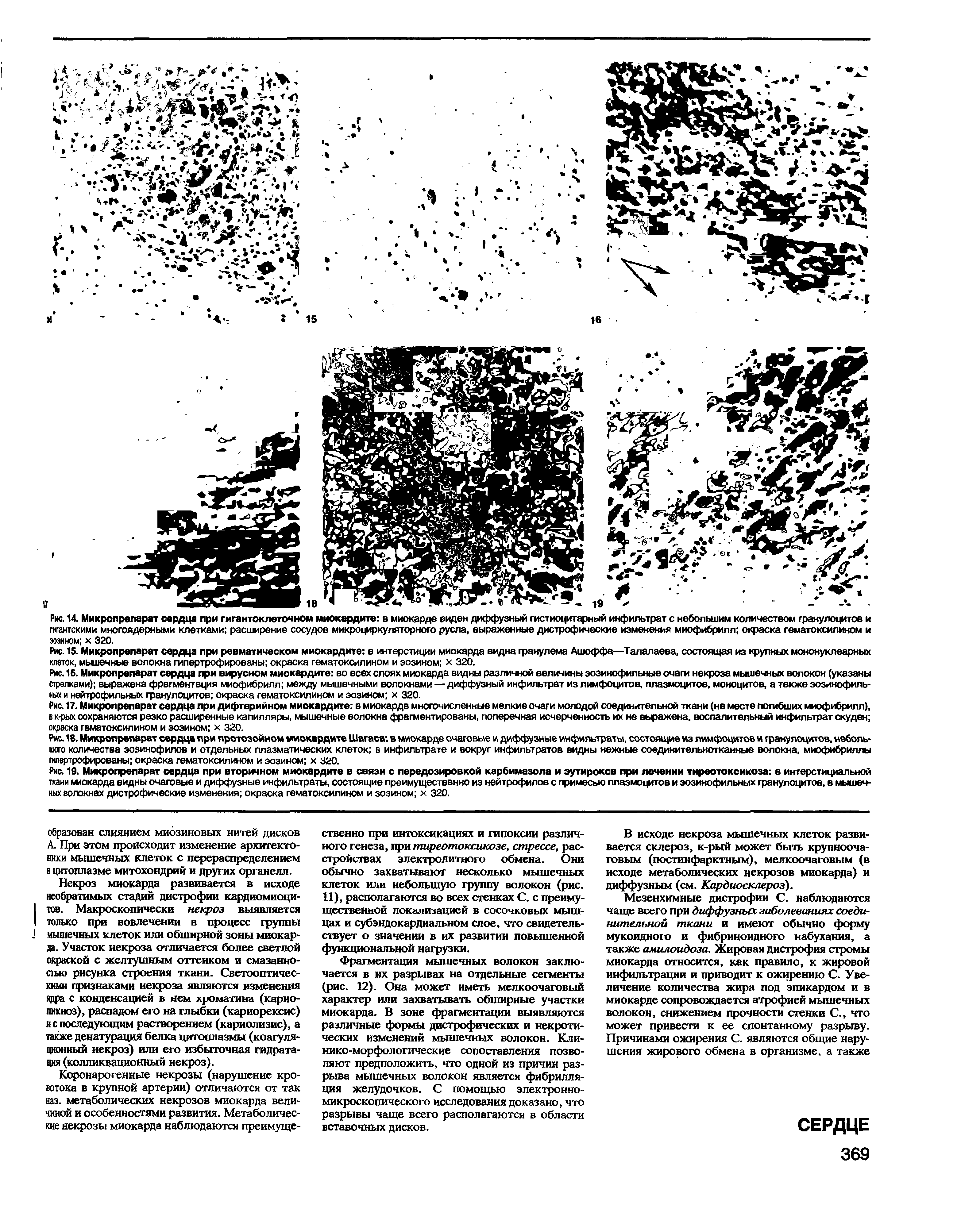 Рис. 15. Микропрепарат сердца при ревматическом миокардите в интерстиции миокарда видна гранулема Ашоффа—Талалаева, состоящая из крупных мононуклеарных клеток, мышечные волокна гипертрофированы окраска гематоксилином и эозином х 320.