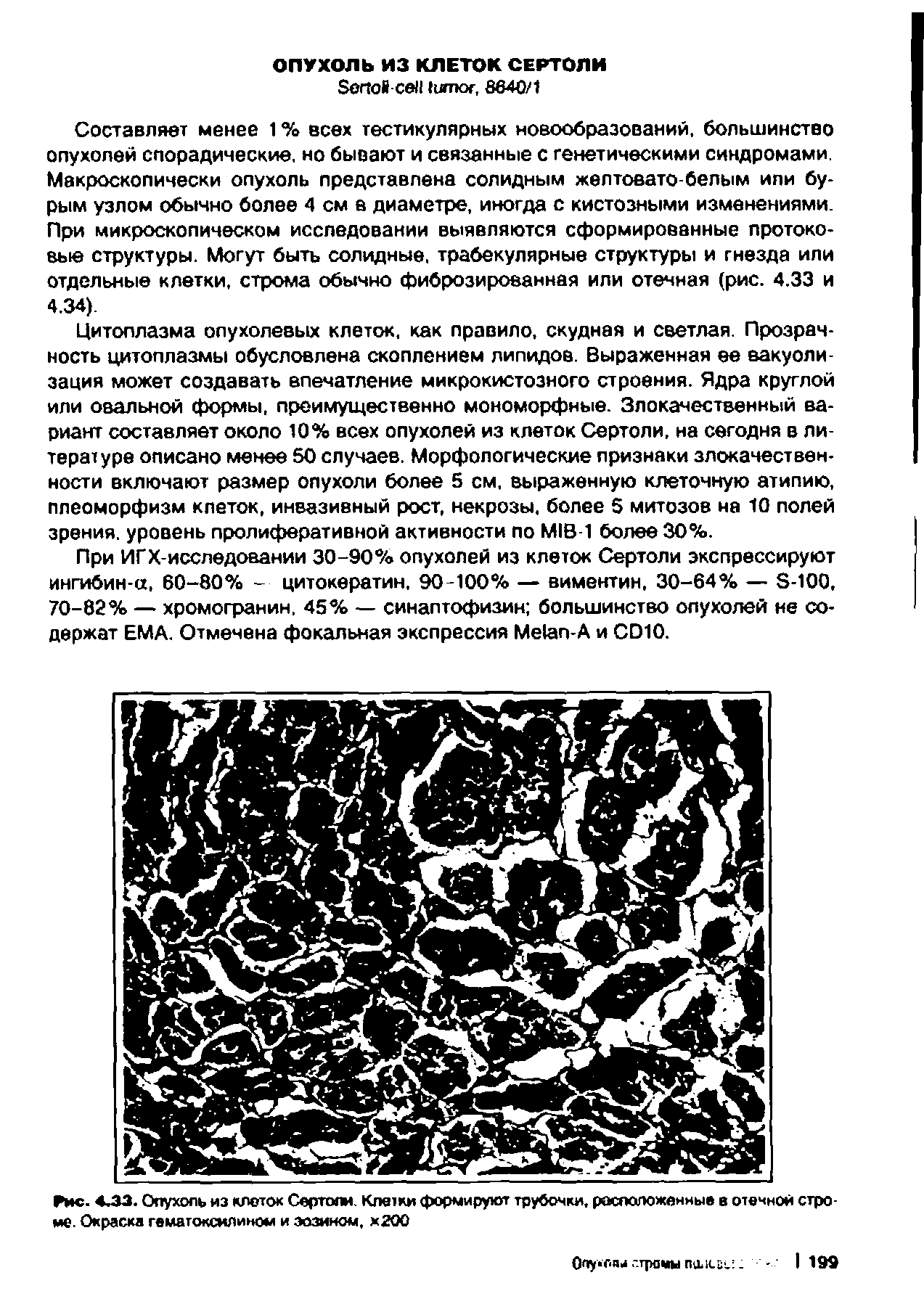 Рис. 4ЛЗ. Опухоль из клеток Сертоли. Клетки формируют трубочки, расположенные в отечной строме. Окраска гематоксилином и эозином, х200...