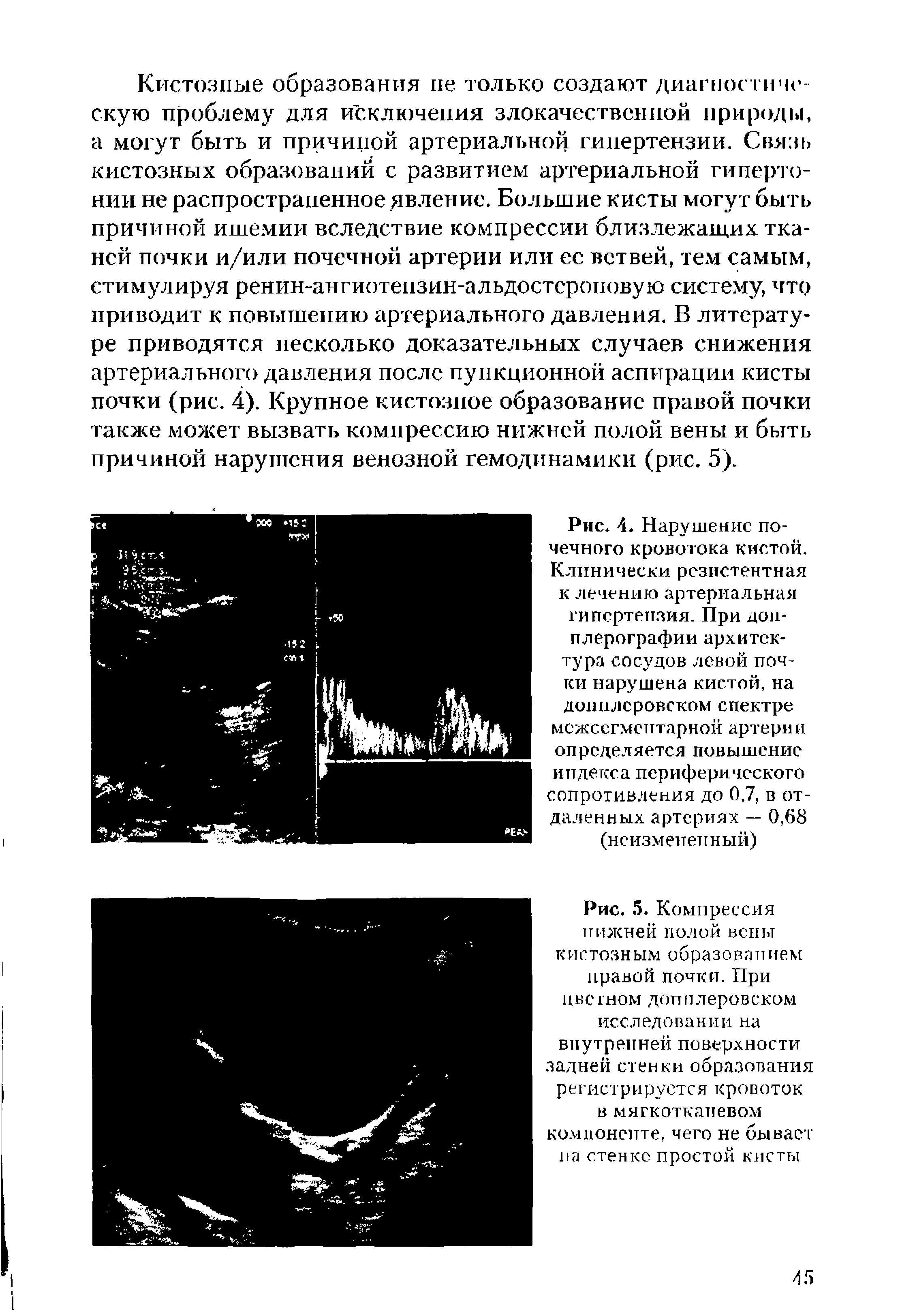 Рис. 4. Нарушение почечного кровотока кистой. Клинически резистентная к лечению артериальная гипертензия. При допплерографии архитектура сосудов левой почки нарушена кистой, на допплеровском спектре мсжссгмсптарной артерии определяется повышение индекса периферического сопротивления до 0.7, в отдаленных артериях — 0,68 (неизмененный)...