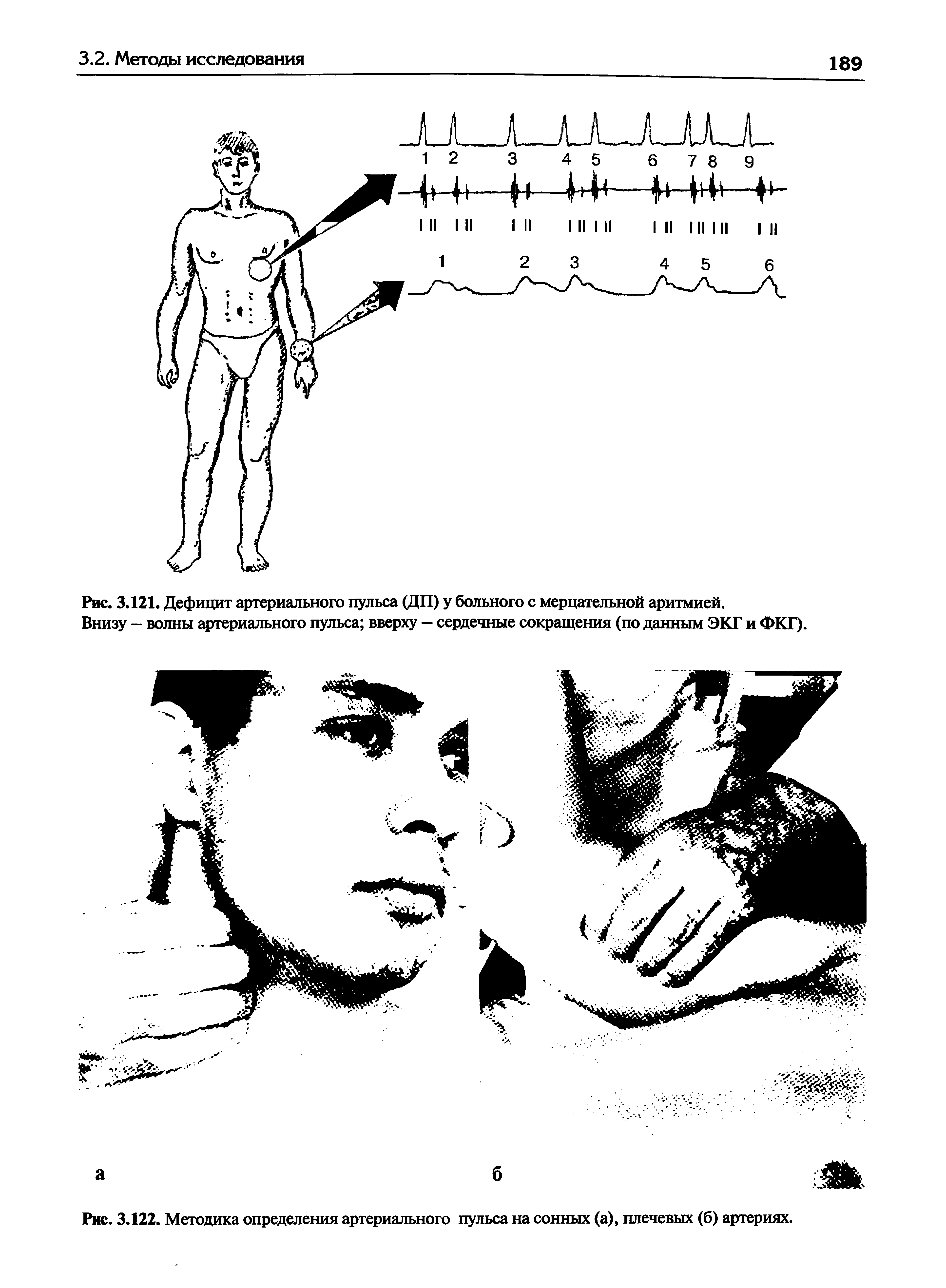 Рис. 3.121. Дефицит артериального пульса (ДП) у больного с мерцательной аритмией.