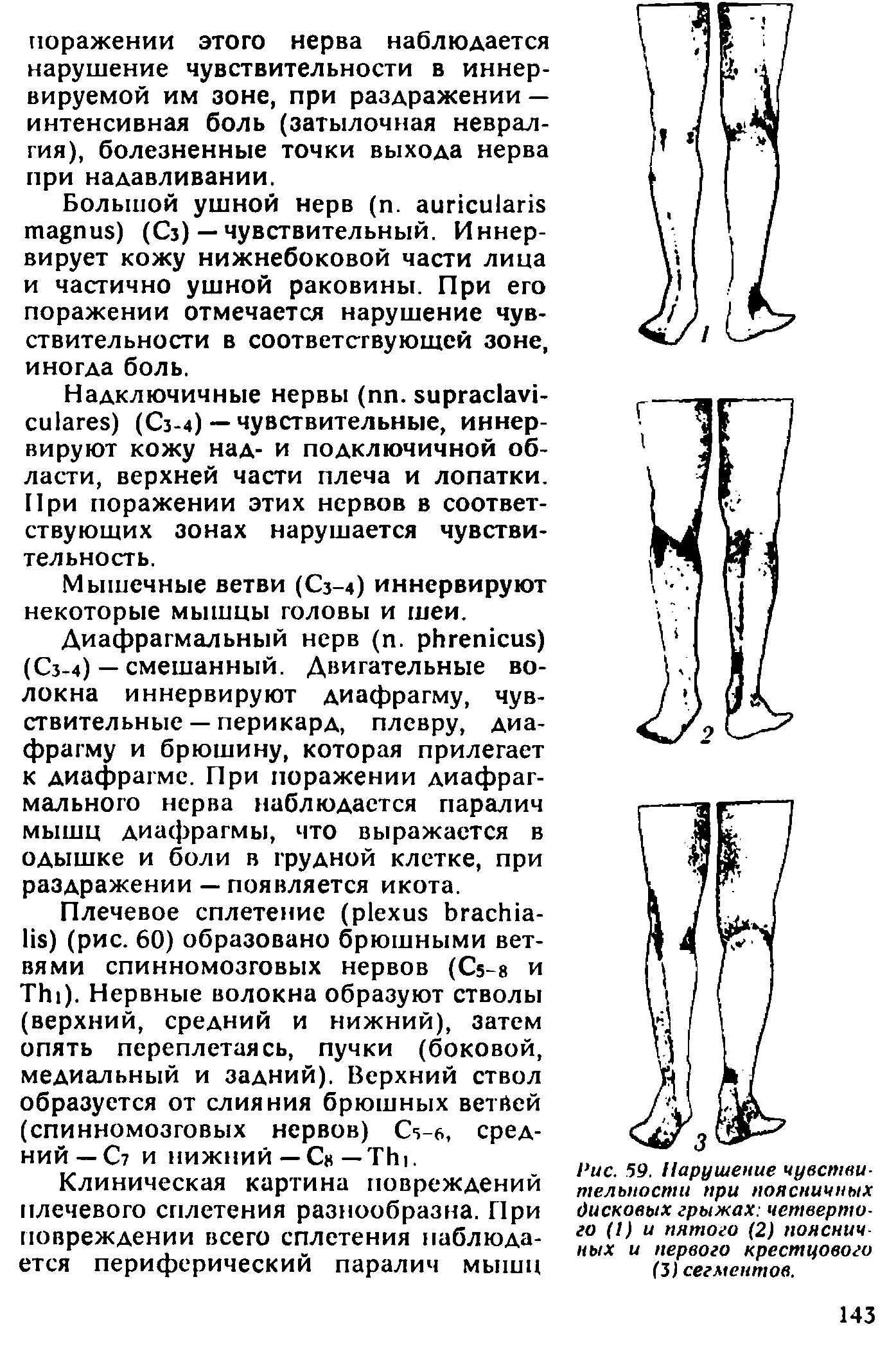 Рис. 59. Нарушение чувствительности при поясничных дисковых грыжах четвертого (I) и пятого (2) поясничных и первого крестцового (31 сегментов.