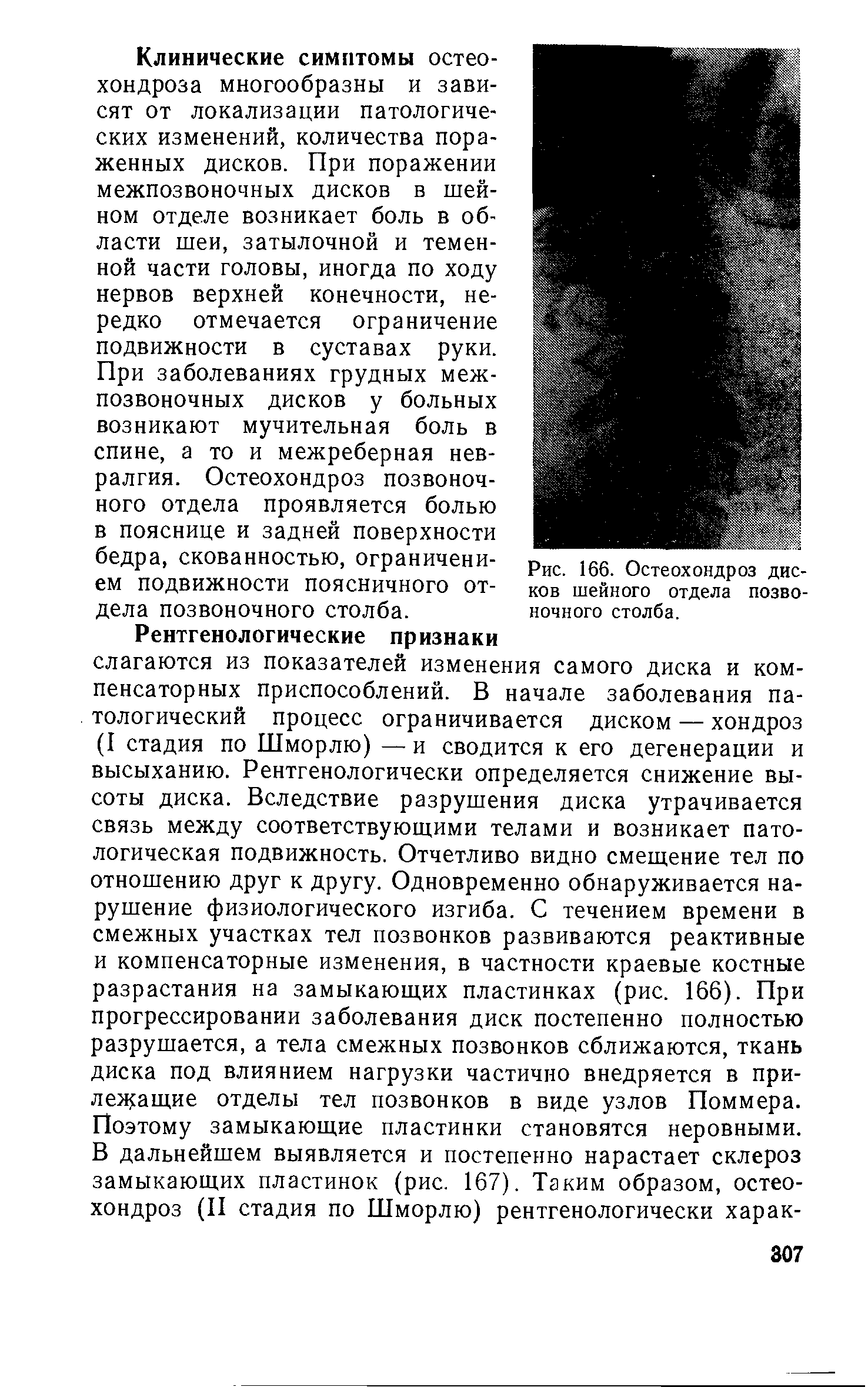 Рис. 166. Остеохондроз дисков шейного отдела позвоночного столба.