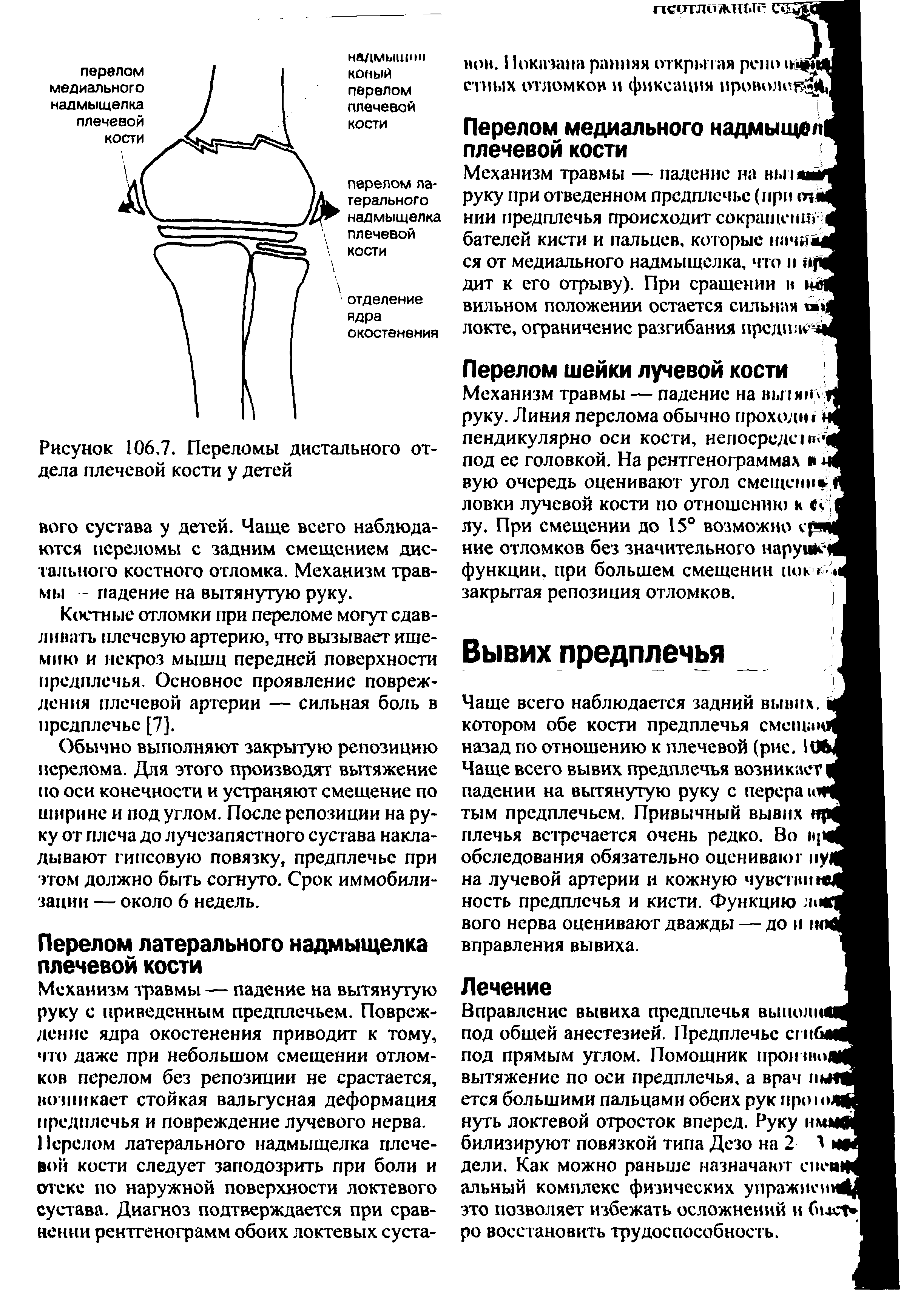 Рисунок 106.7. Переломы дистального отдела плечевой кости у детей...