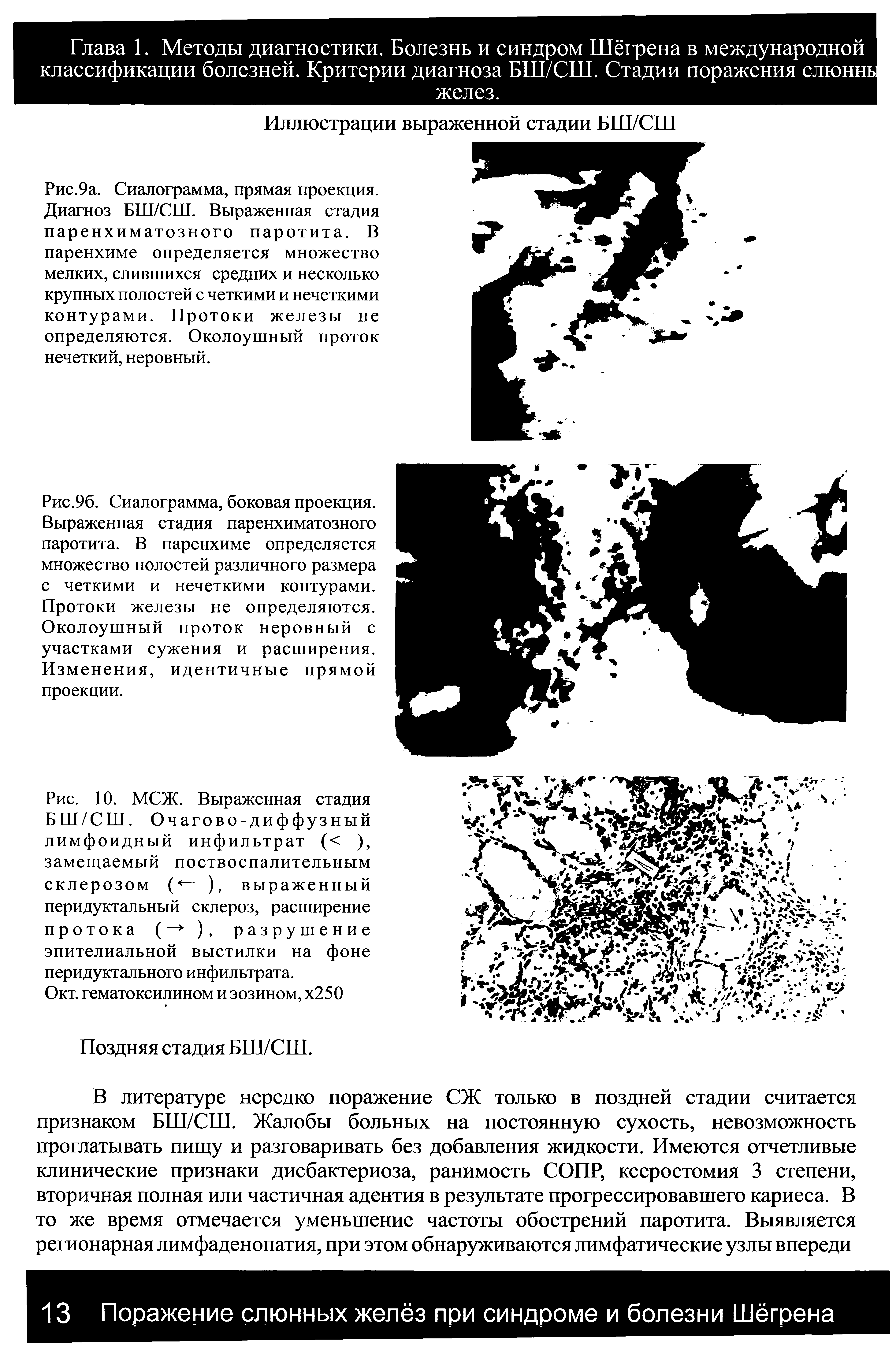 Рис.9а. Сиалограмма, прямая проекция. Диагноз БШ/СШ. Выраженная стадия паренхиматозного паротита. В паренхиме определяется множество мелких, слившихся средних и несколько крупных полостей с четкими и нечеткими контурами. Протоки железы не определяются. Околоушный проток нечеткий, неровный.