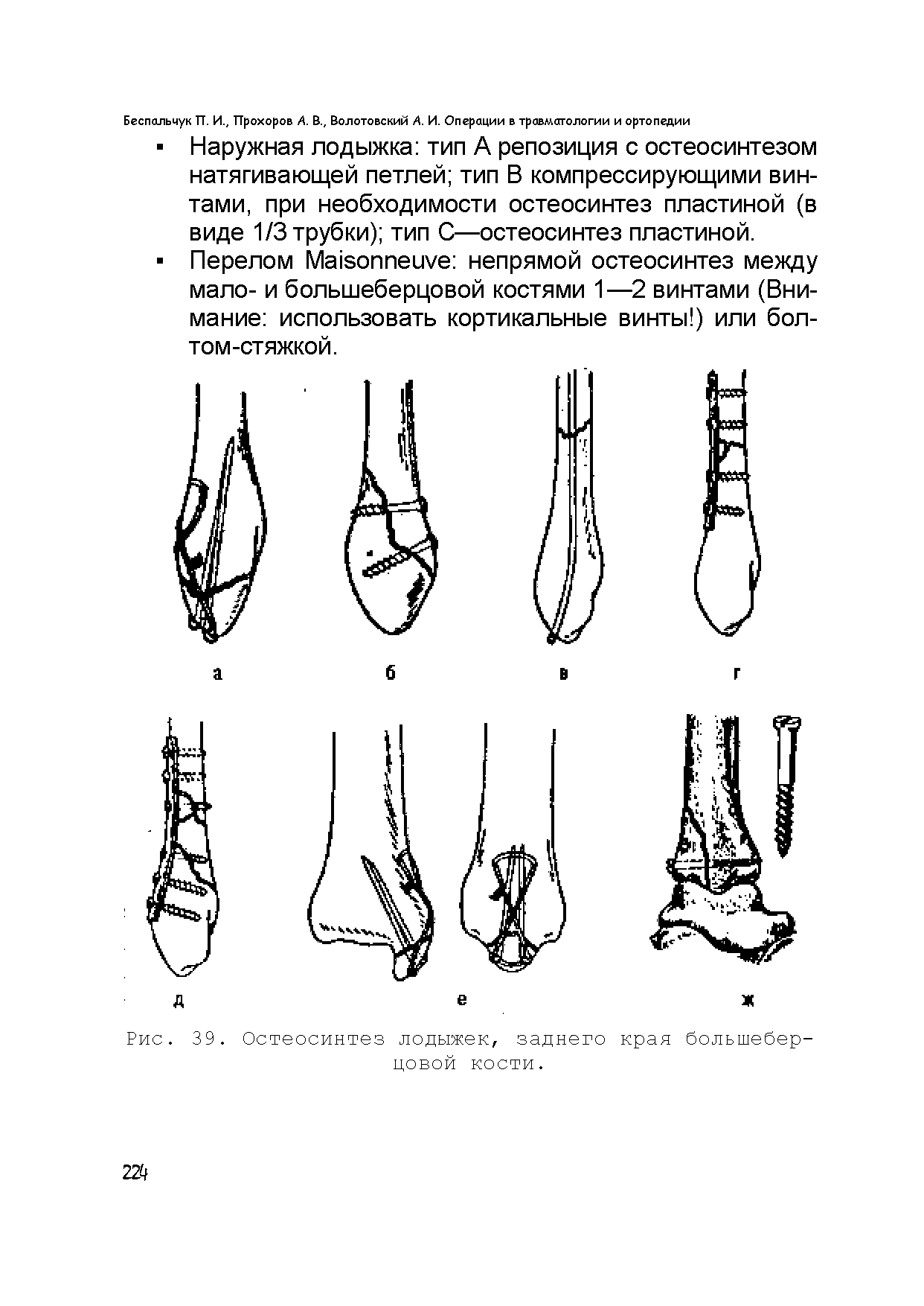 Рис. 39. Остеосинтез лодыжек, заднего края большеберцовой кости.