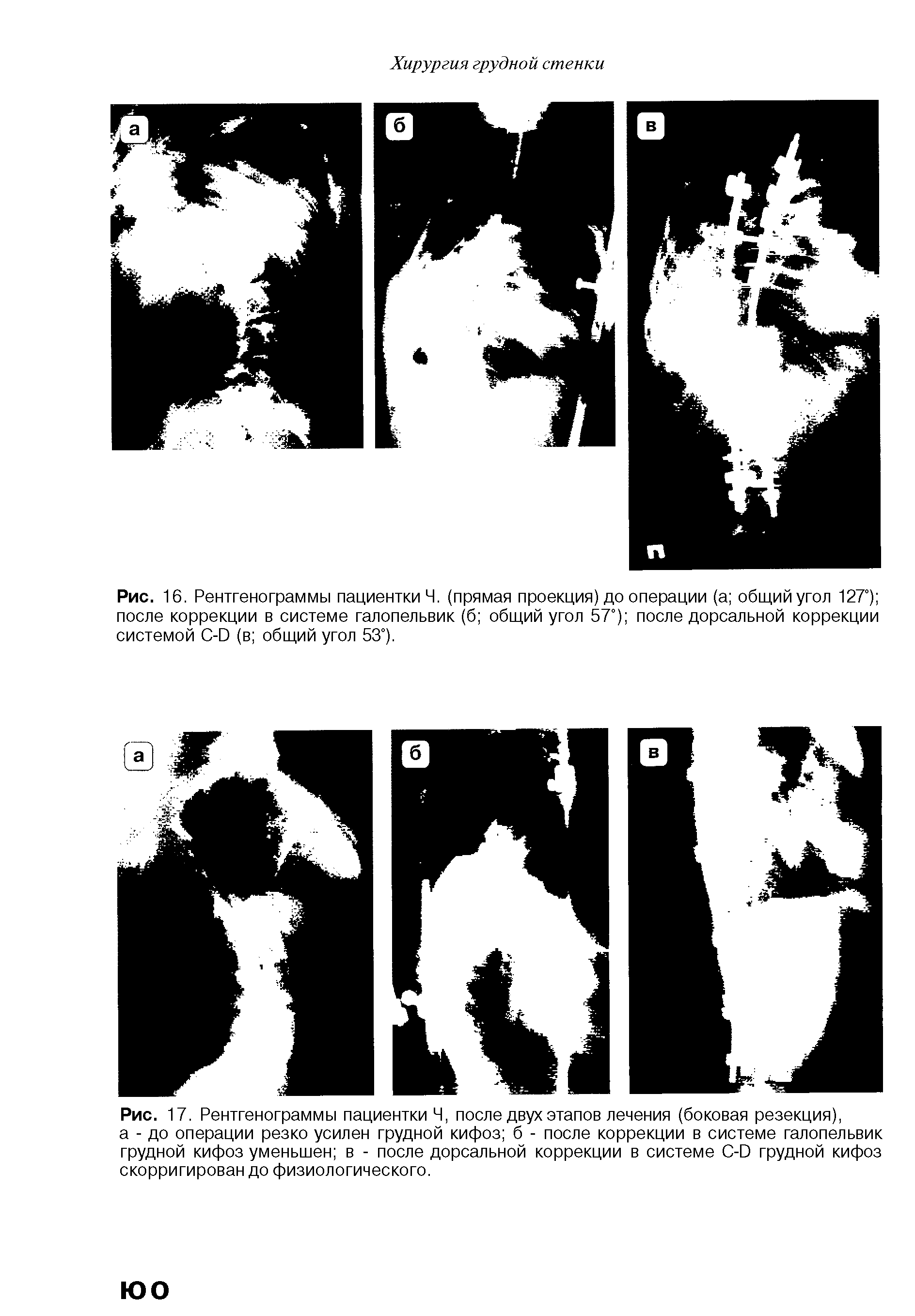 Рис. 17. Рентгенограммы пациентки Ч, после двух этапов лечения (боковая резекция), а - до операции резко усилен грудной кифоз б - после коррекции в системе галопельвик грудной кифоз уменьшен в - после дорсальной коррекции в системе С-Ю грудной кифоз скорригирован до физиологического.