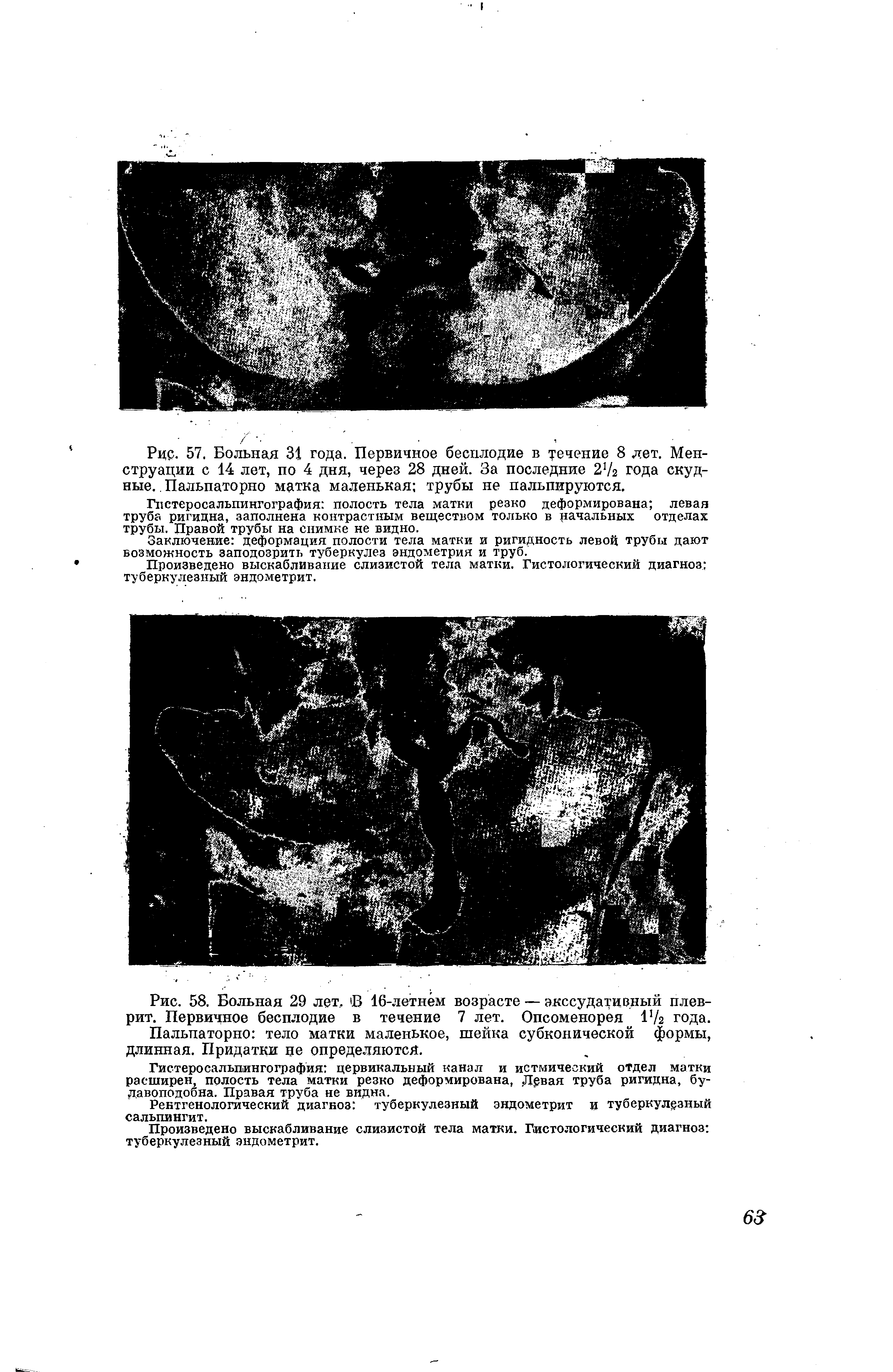 Рис. 58. Больная 29 лет, Б 16-летнем возрасте — экссудативный плеврит. Первичное бесплодие в течение 7 лет. Опсоменорея Н/г года.