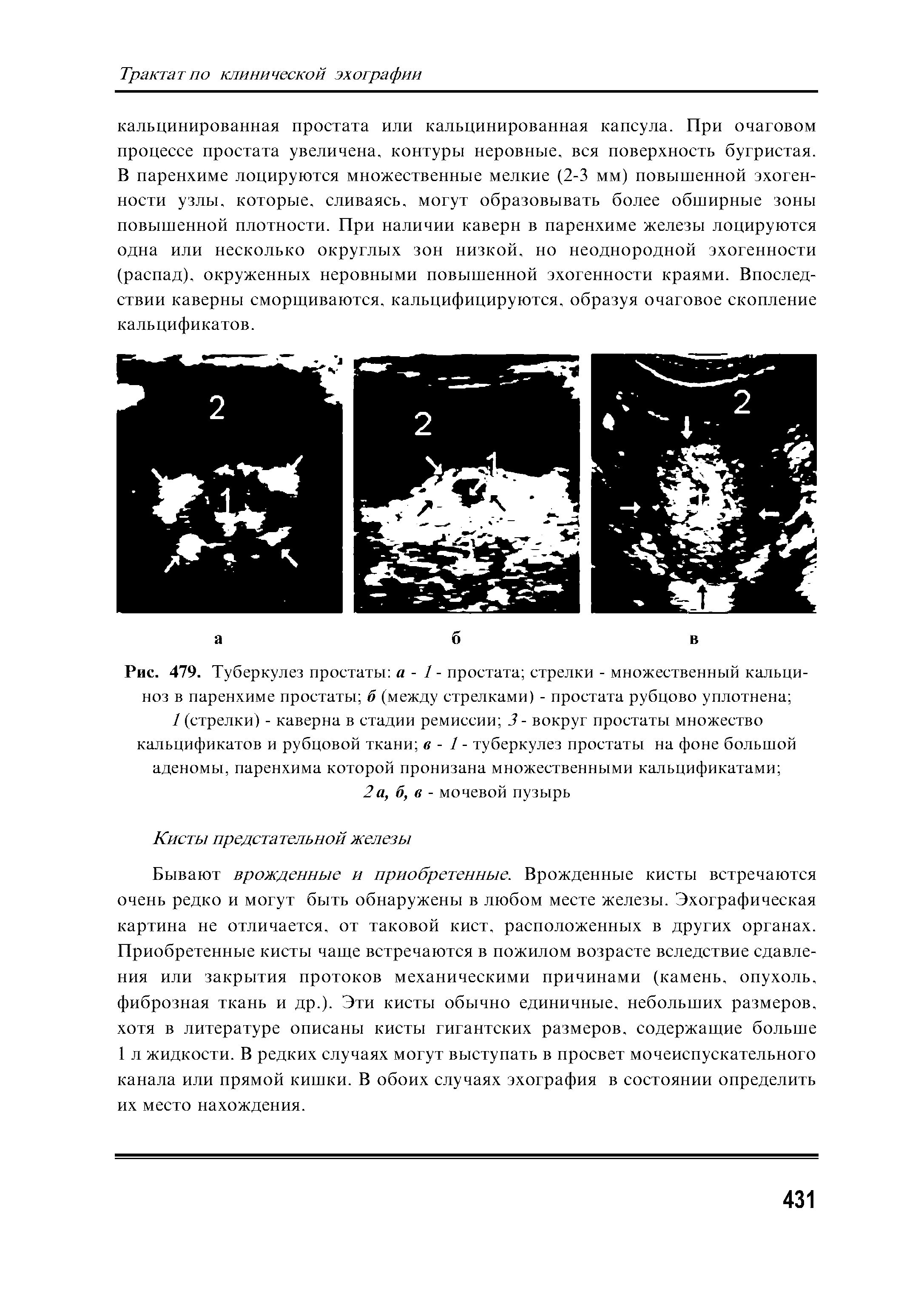 Рис. 479. Туберкулез простаты а - 1 - простата стрелки - множественный кальциноз в паренхиме простаты б (между стрелками) - простата рубцово уплотнена ...