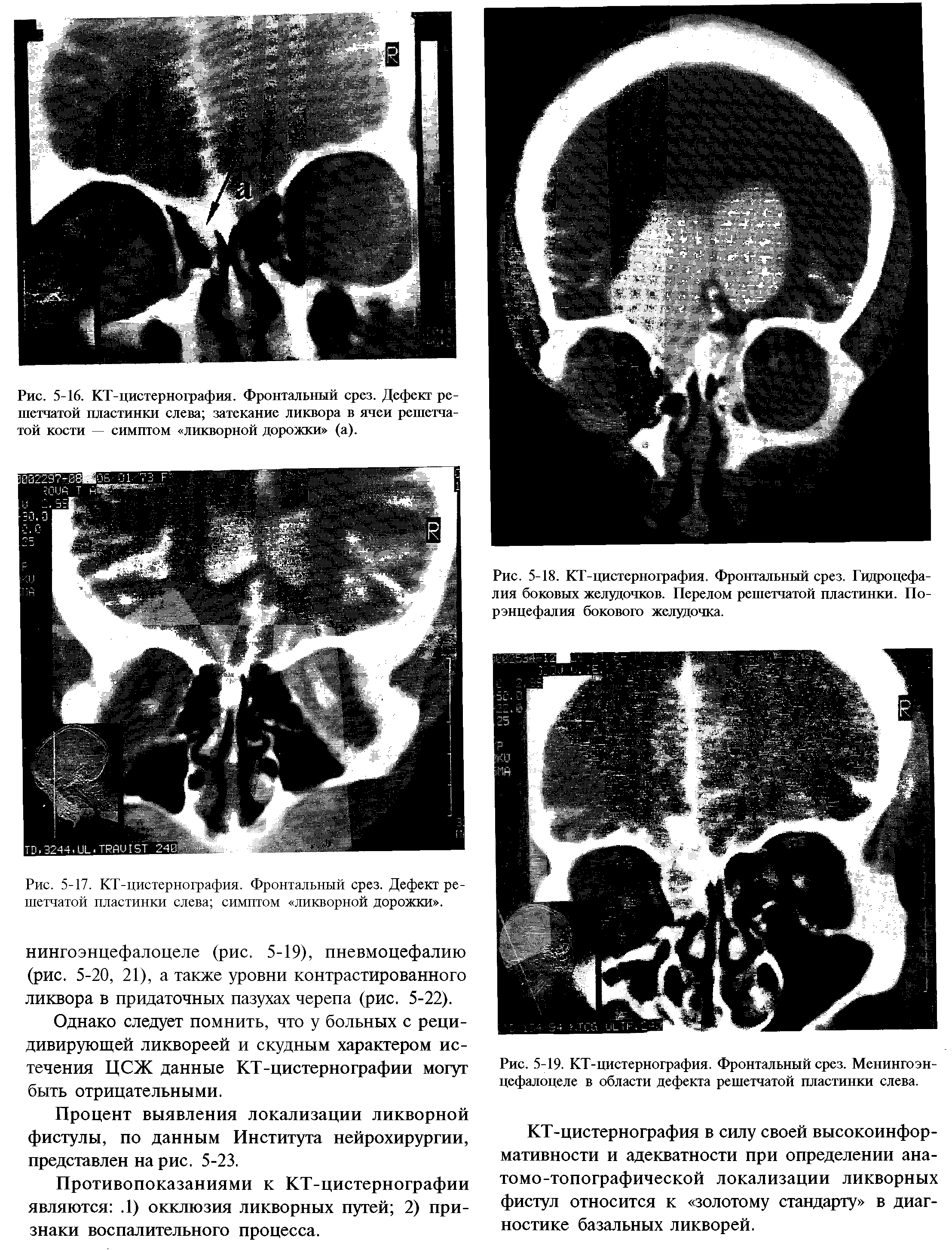 Рис. 5-18. КТ-цистернография. Фронтальный срез. Гидроцефалия боковых желудочков. Перелом решетчатой пластинки. По-рэнцефалия бокового желудочка.