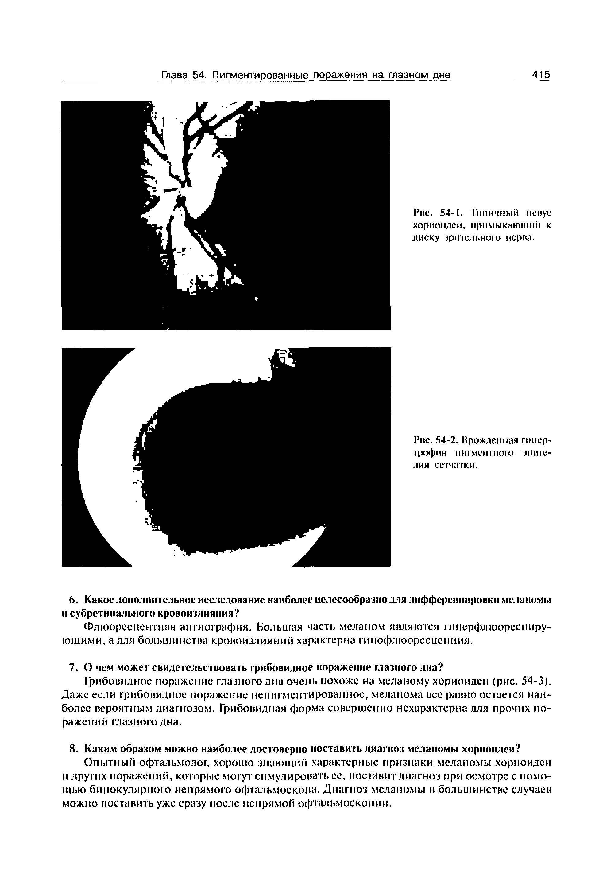 Рис. 54-1. Типичный невус хориоидеи. примыкающий к лиску зрительного нерва.