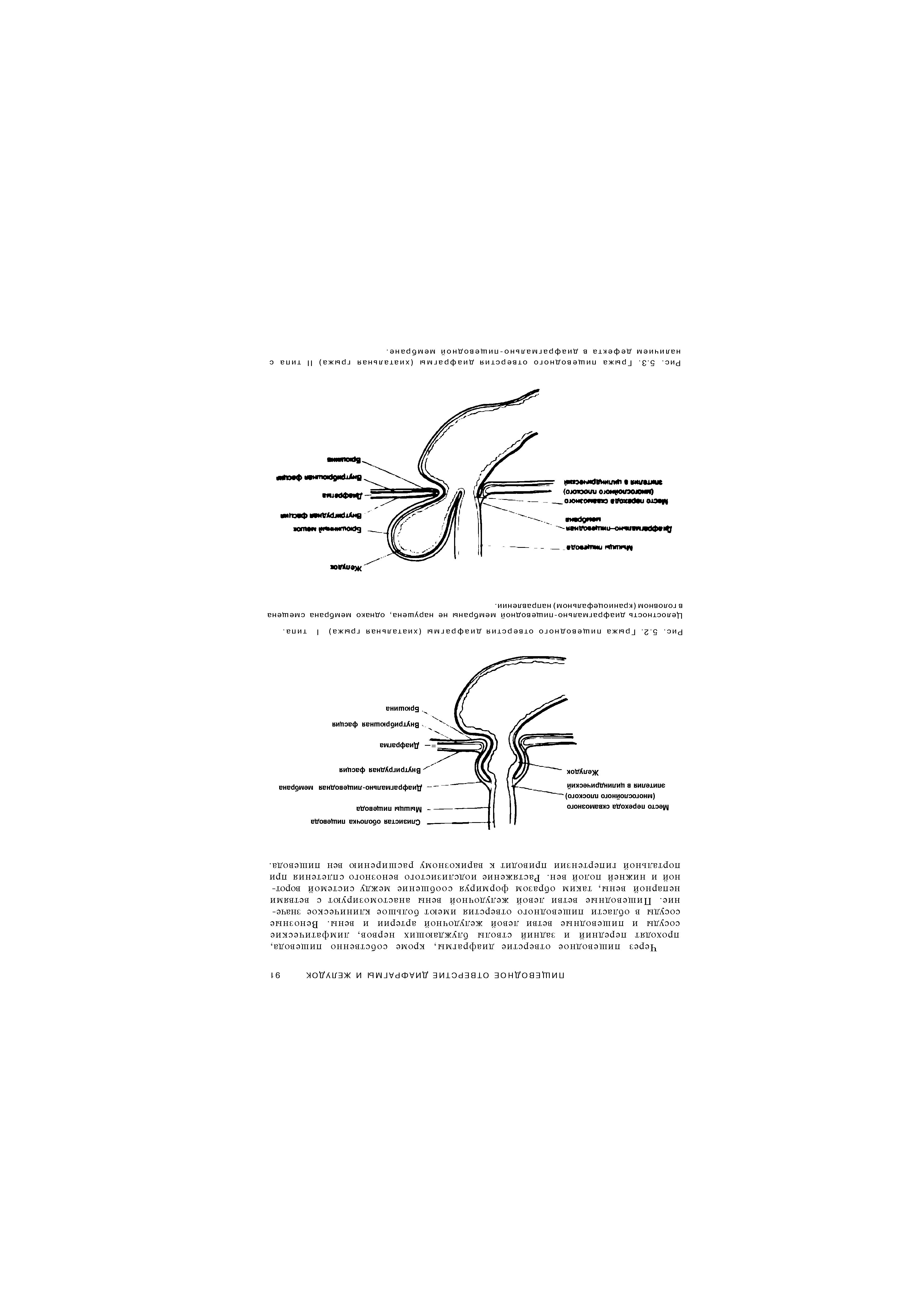 Рис. 5.2. Грыжа пищеводного отверстия диафрагмы (хиатальная грыжа) I типа.