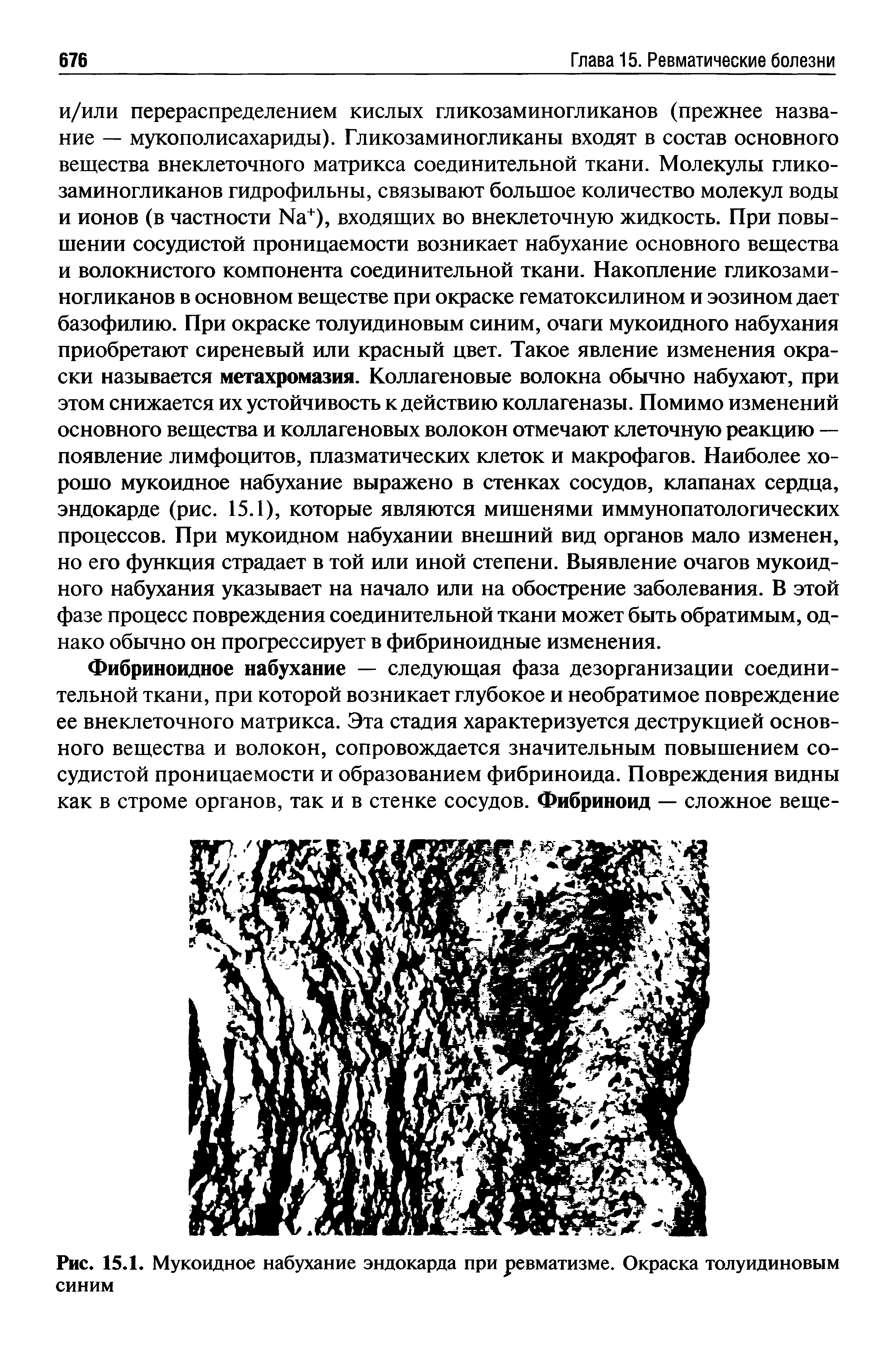 Рис. 15.1. Мукоидное набухание эндокарда при ревматизме. Окраска толуидиновым синим...