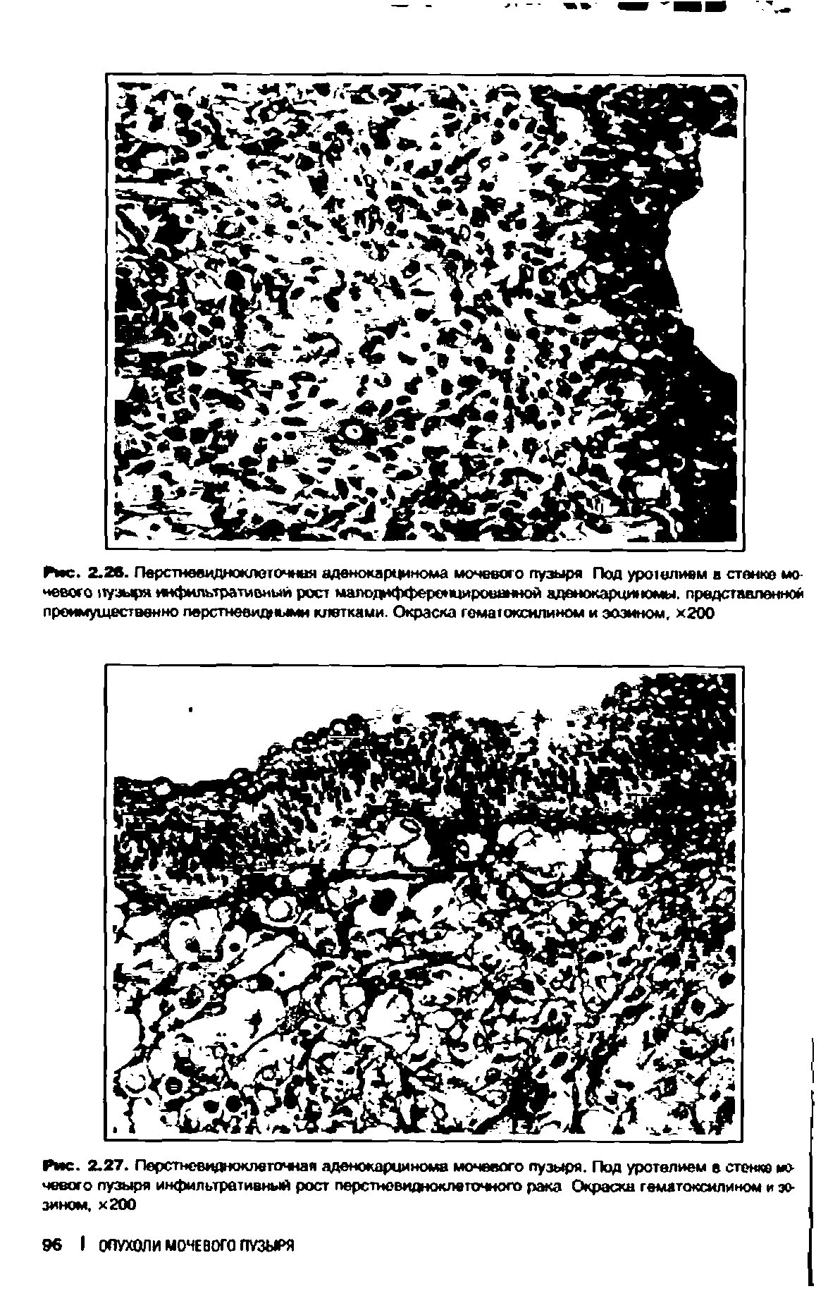 Рис. 2.27. Перстневидноклеточная аденокарцинома мочевого пузыря. Под уротелием в стенке ио чевого пузыря инфильтративный рост перстневидноклеточного рака Окраска гематоксилином и эозином, х200...