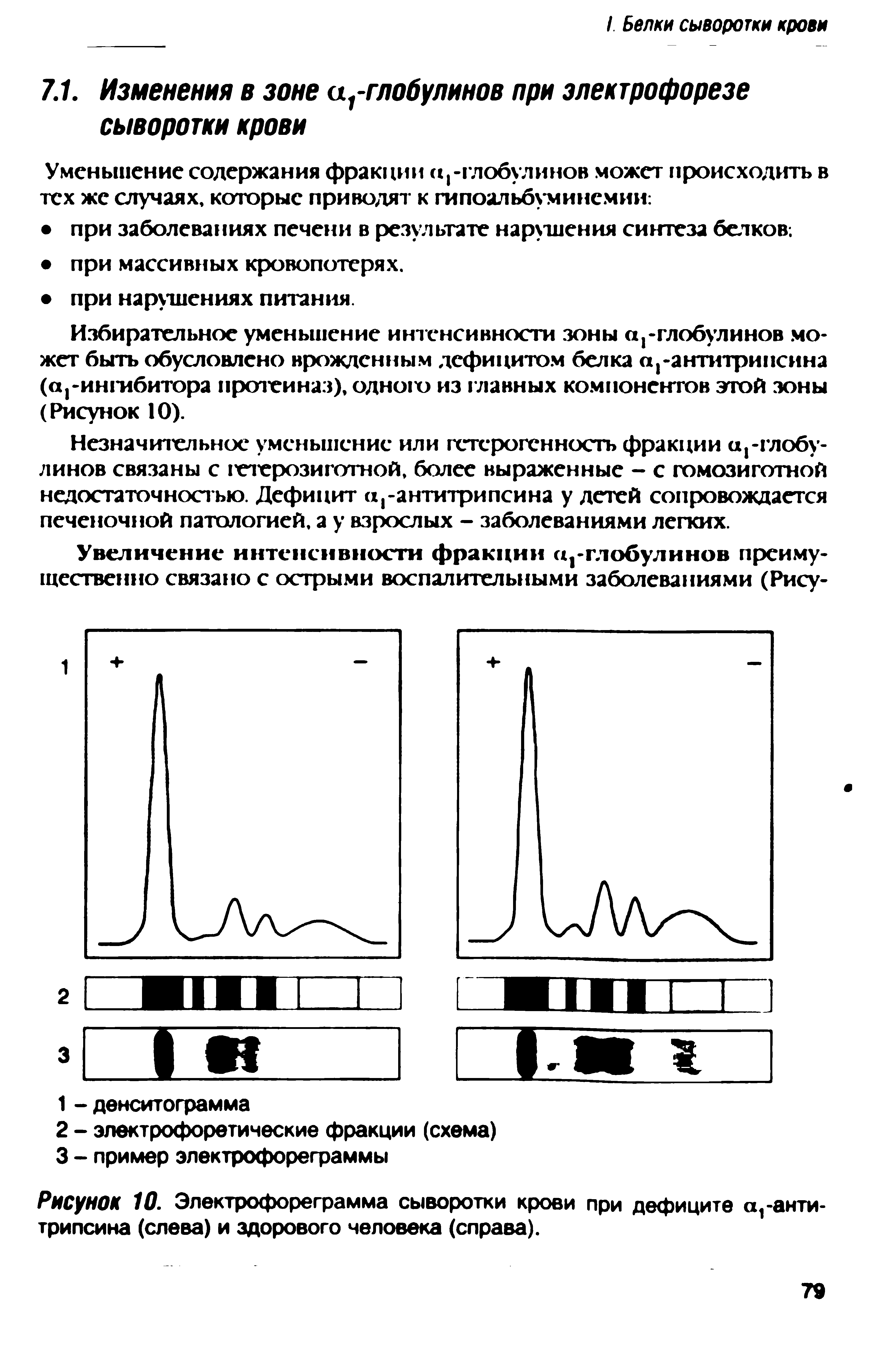 Рисунок 10. Электрофореграмма сыворотки крови при дефиците а,-антитрипсина (слева) и здорового человека (справа).