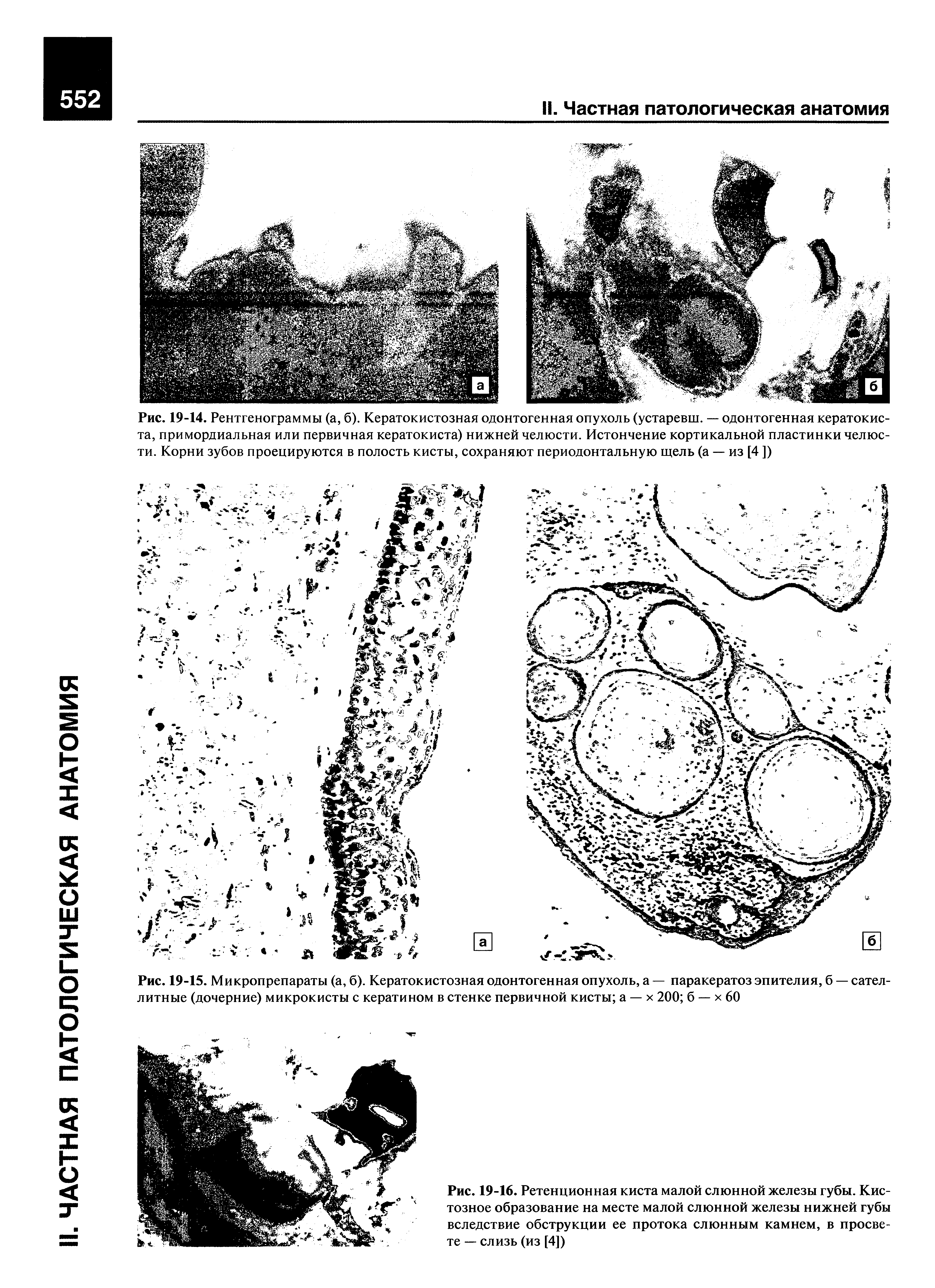 Рис. 19-16. Ретенционная киста малой слюнной железы губы. Кистозное образование на месте малой слюнной железы нижней губы вследствие обструкции ее протока слюнным камнем, в просвете — слизь (из [4])...