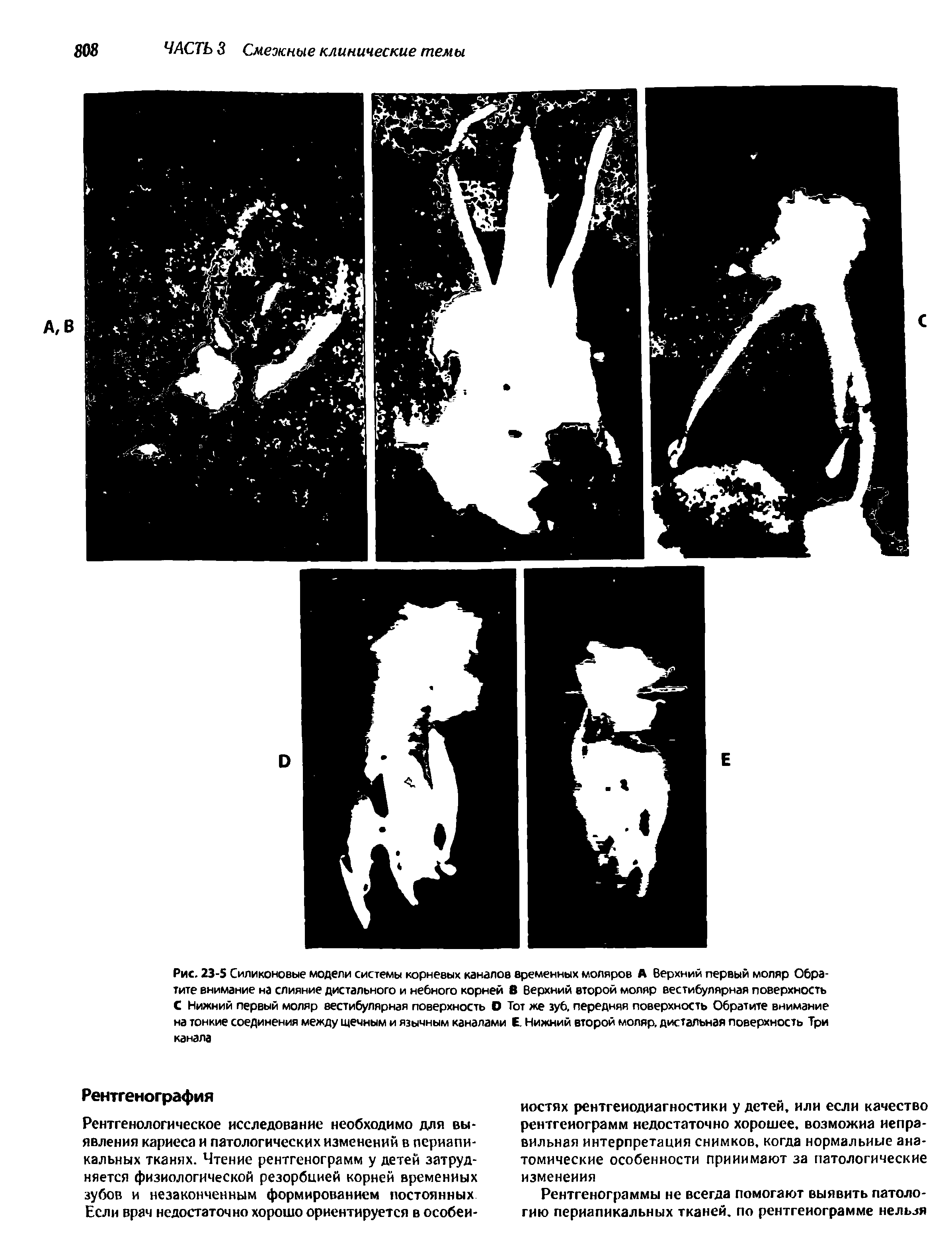 Рис. 23-5 Силиконовые модели системы корневых каналов временных моляров А Верхний первый моляр Обратите внимание на слияние дистального и небного корней В Верхний второй моляр вестибулярная поверхность С Нижний первый моляр вестибулярная поверхность О Тот же зуб. передняя поверхность Обратите внимание на тонкие соединения между щечным и язычным каналами Е. Нижний второй моляр, дистальная поверхность Три канала...