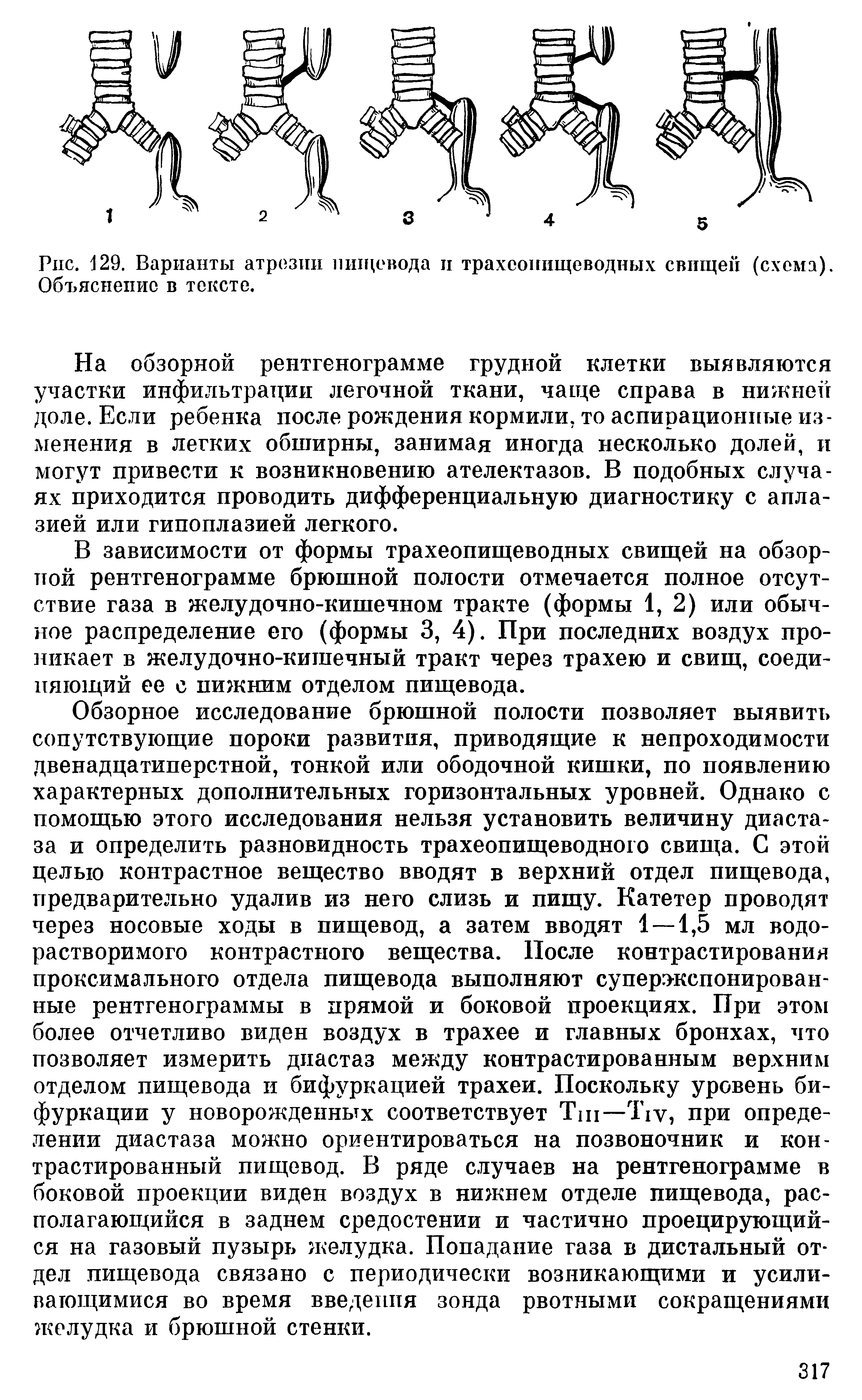 Рис. 129. Варианты атрезии пищевода и трахеопищеводных свищей (схема). Объяснение в тексте.