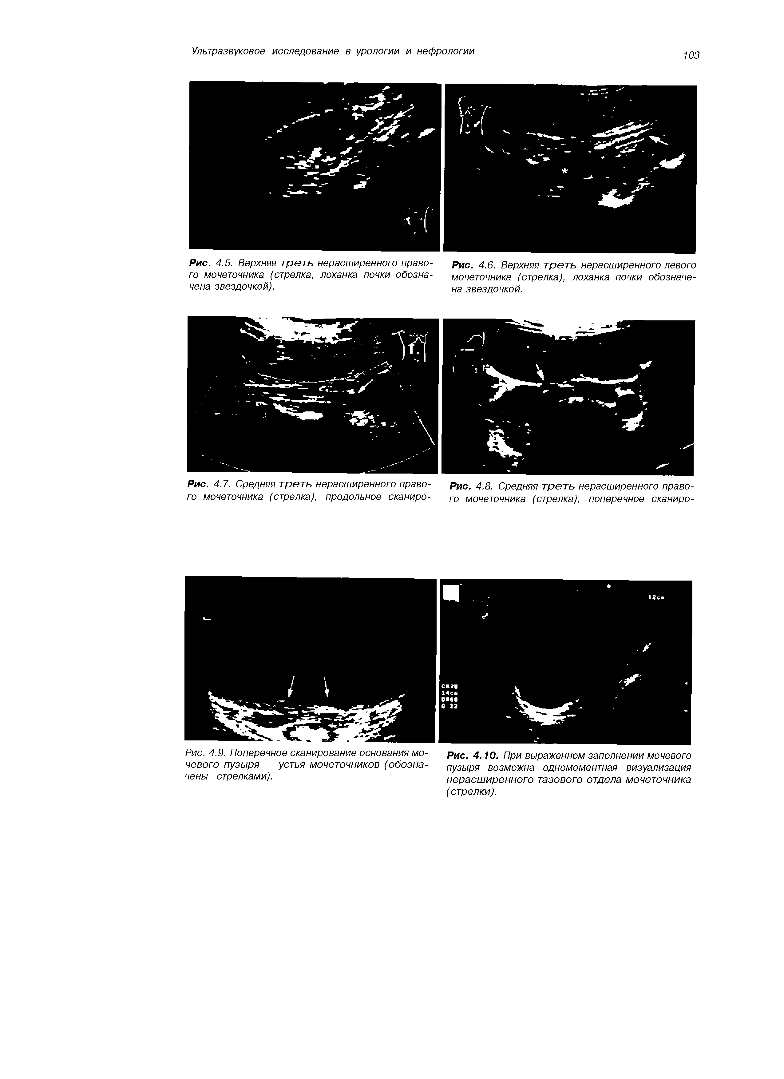 Рис. 4.9. Поперечное сканирование основания мочевого пузыря — устья мочеточников (обозначены стрелками).