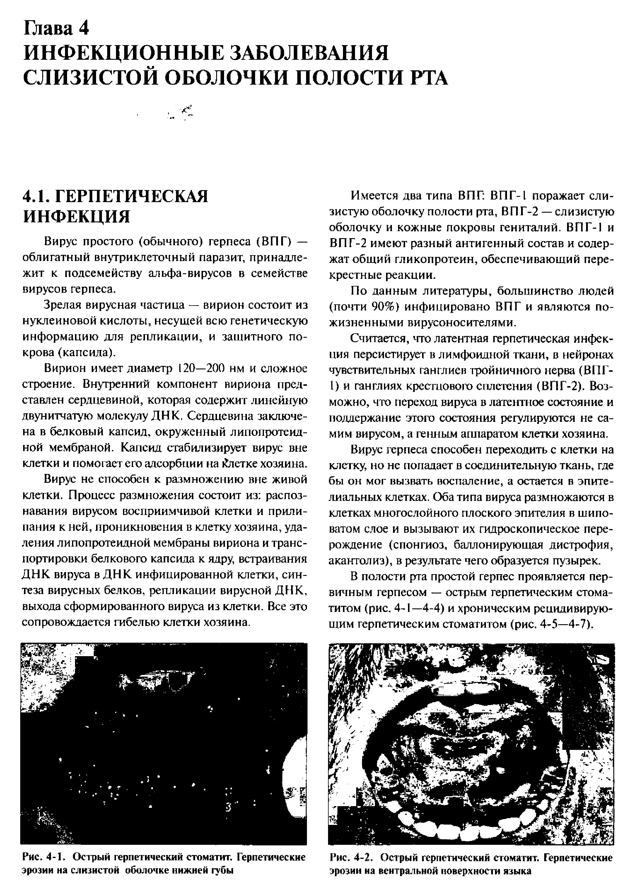 Рис. 4-1. Острый герпетический стоматит. Герпетические эрозии на слизистой оболочке нижней губы...