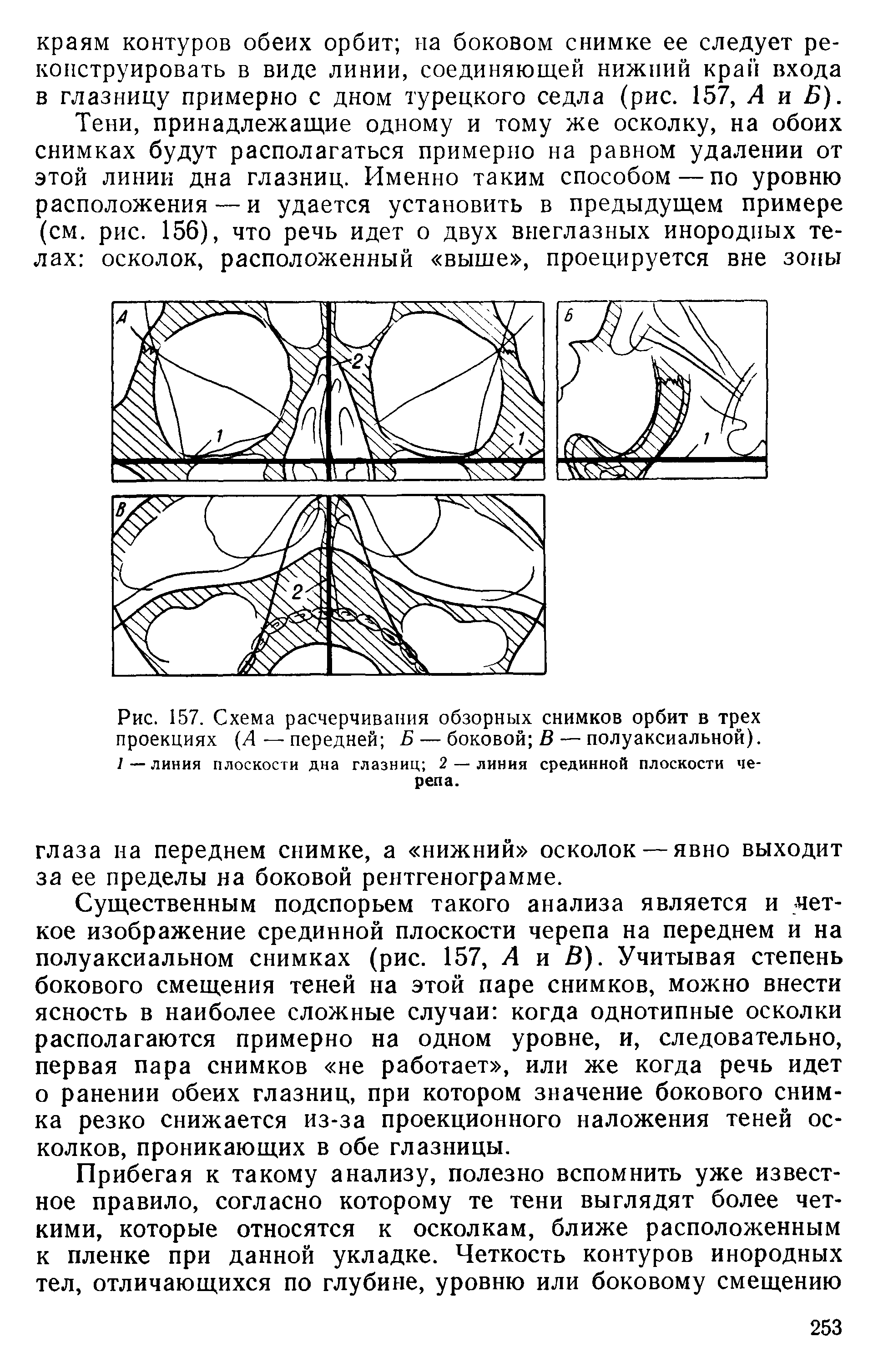 Рис. 157. Схема расчерчивания обзорных снимков орбит в трех проекциях (Д — передней Б — боковой В — полуаксиальной). 1—линия плоскости дна глазниц 2 — линия срединной плоскости черепа.