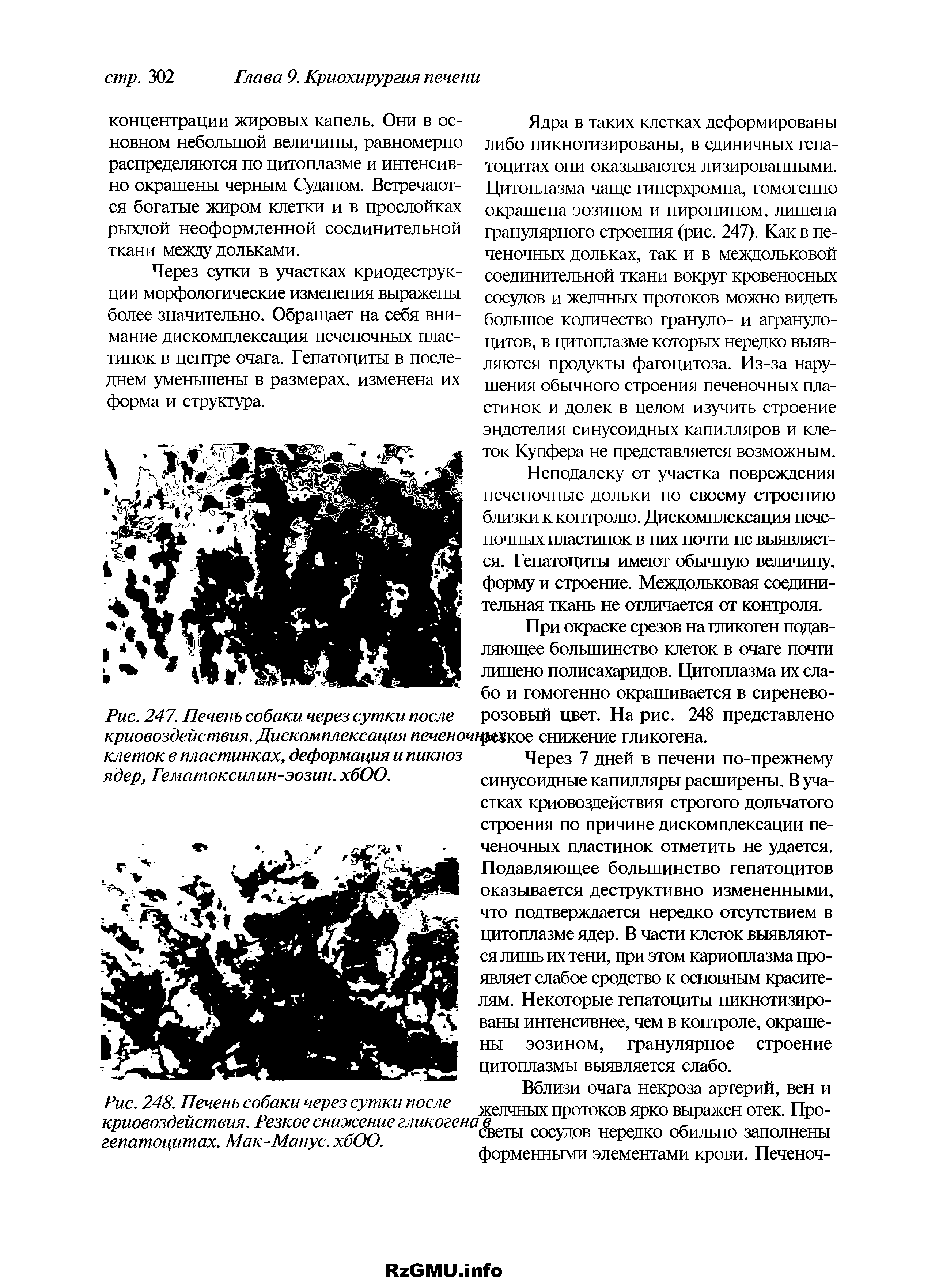 Рис. 248. Печень собаки через сутки после криовоздействия. Резкое снижение гликогенов гепатоцитах. Мак-Манус. хбОО.