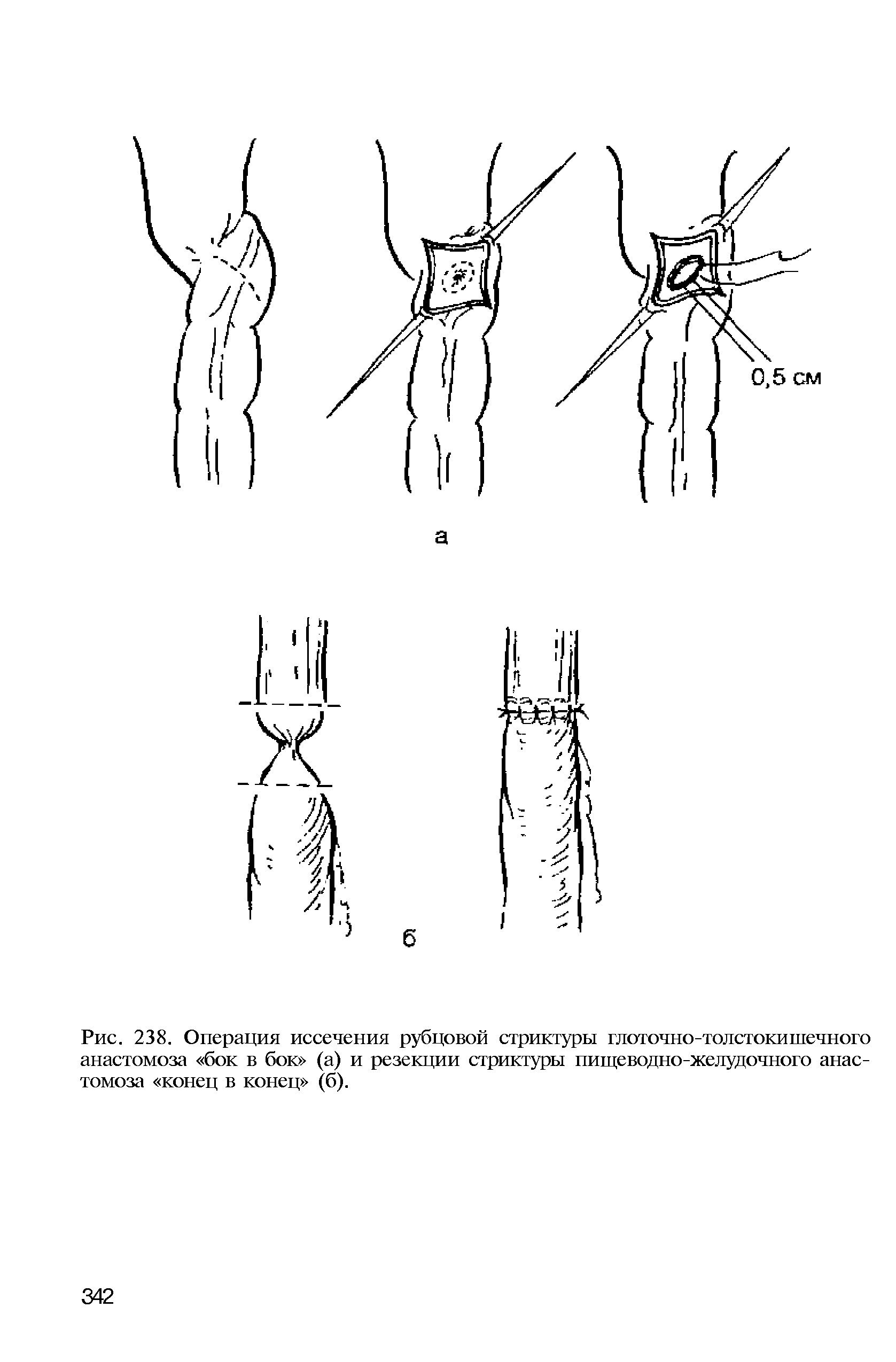 Рис. 238. Операция иссечения рубцовой стриктуры глоточно-толстокишечного анастомоза бок в бок (а) и резекции стриктуры пищеводно-желудочного анастомоза конец в конец (б).