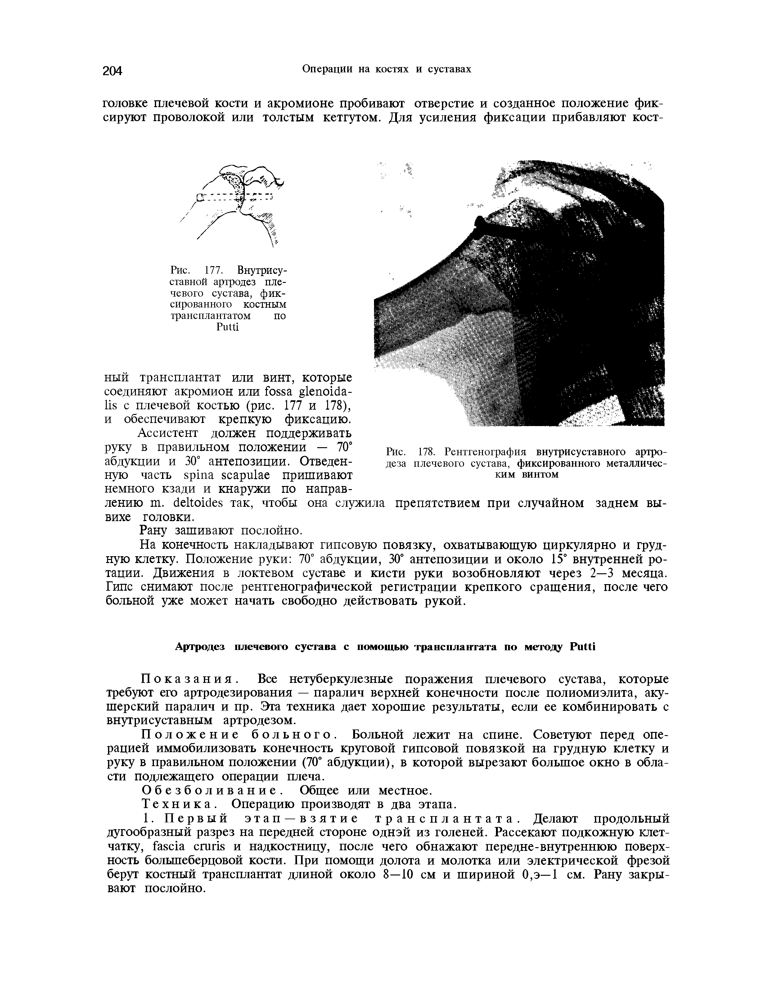 Рис. 177. Внутрисуставной артродез плечевого сустава, фиксированного костным трансплантатом по РиШ...